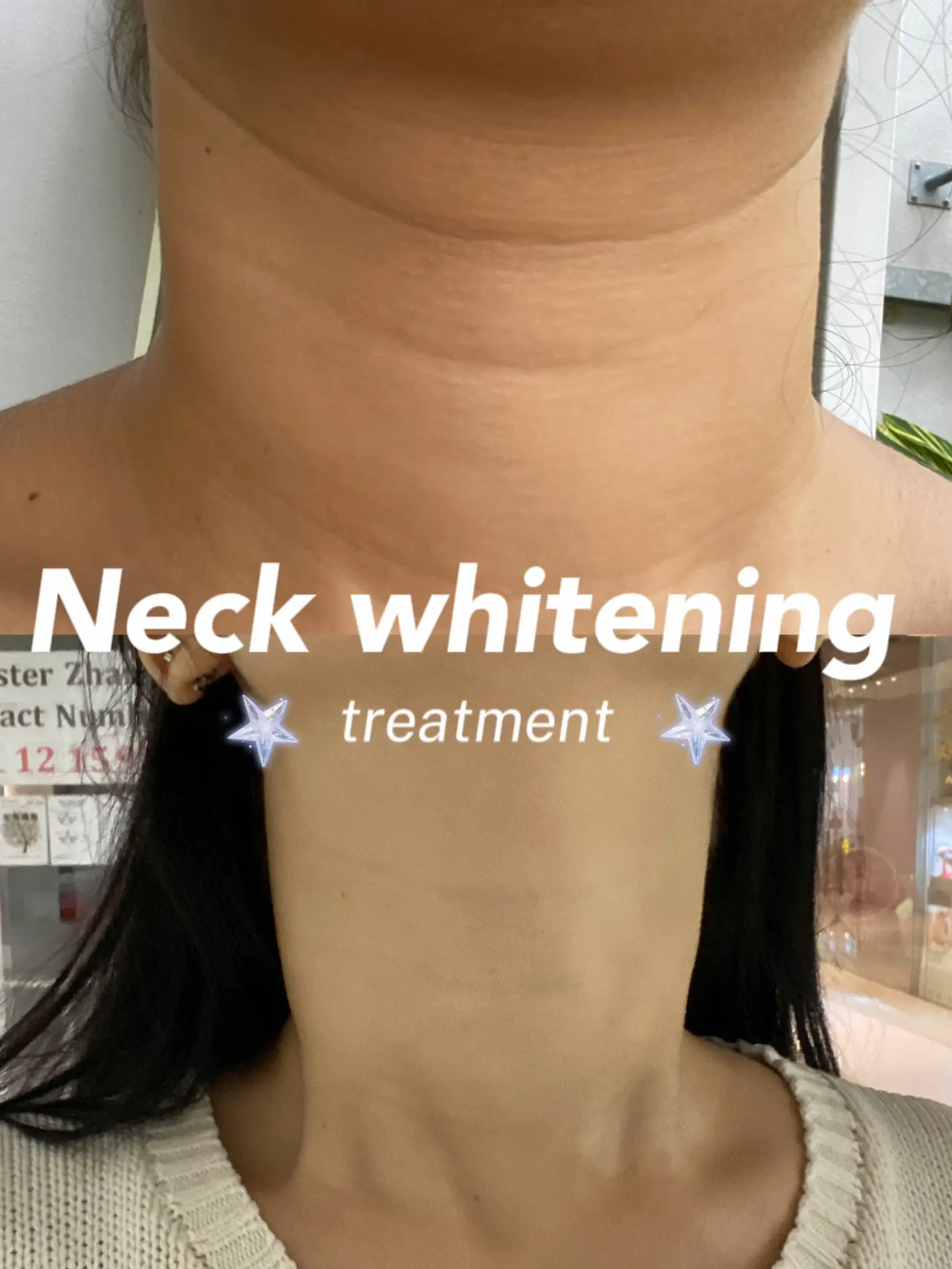 Affordable Neck whitening treatment in SG Gallery posted by