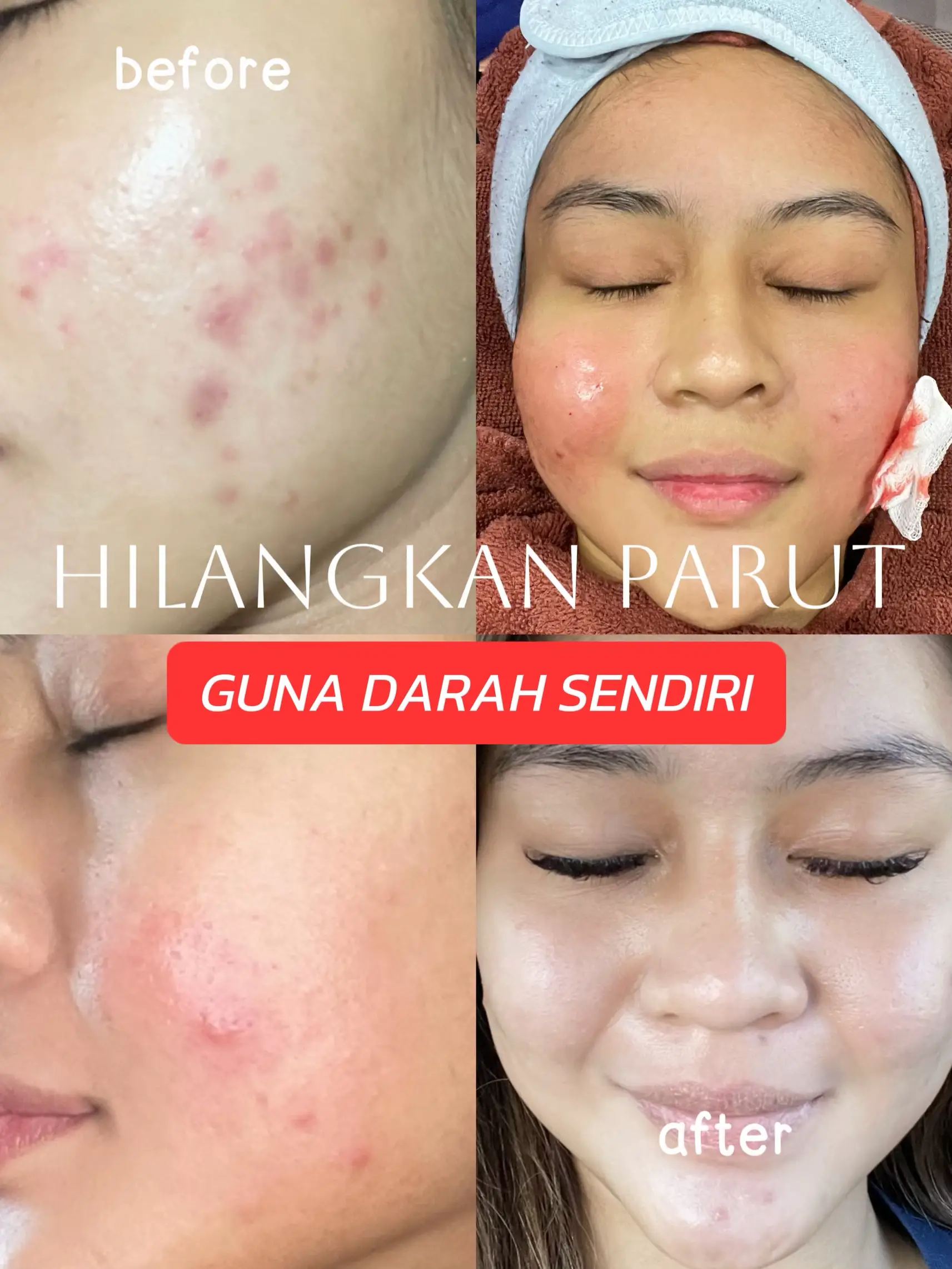 treatment-untuk-hilangkan-parut-sakit-ke-galeri-disiarkan-oleh