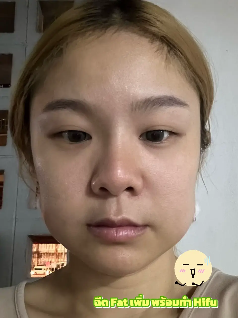 รีวิวเรียลๆ Fat+Botox+Hifu 📍ธรรมดาคลินิก | แกลเลอรีที่โพสต์โดย ...