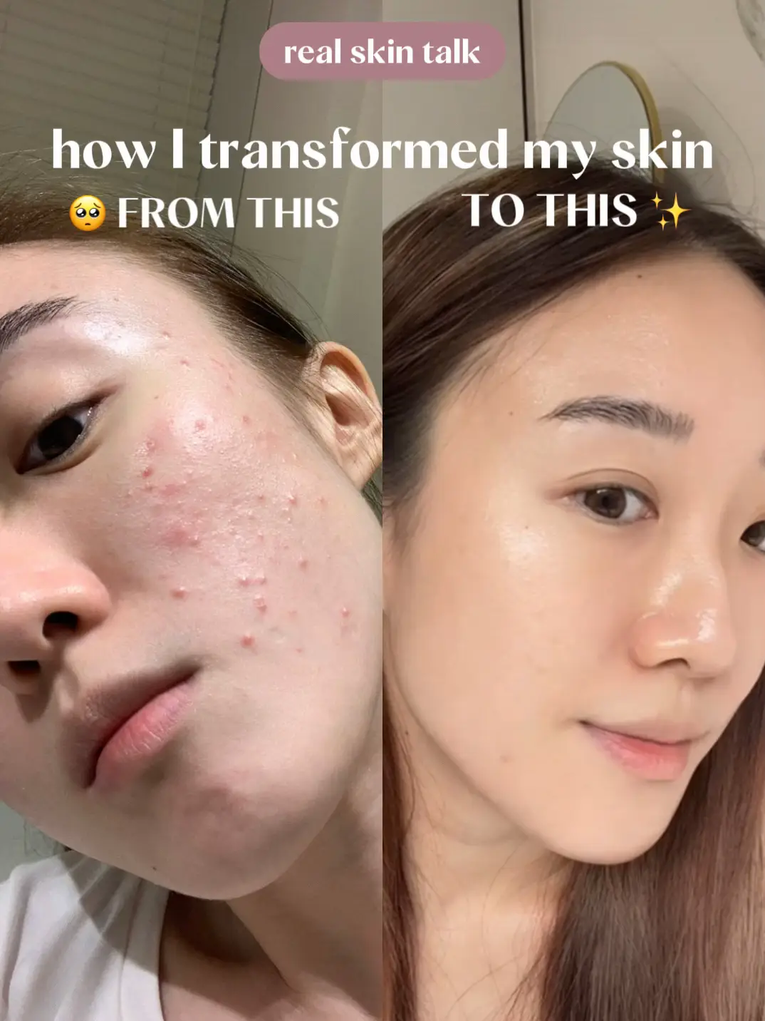 Acne tips and products that changed my life 😭's images(0)