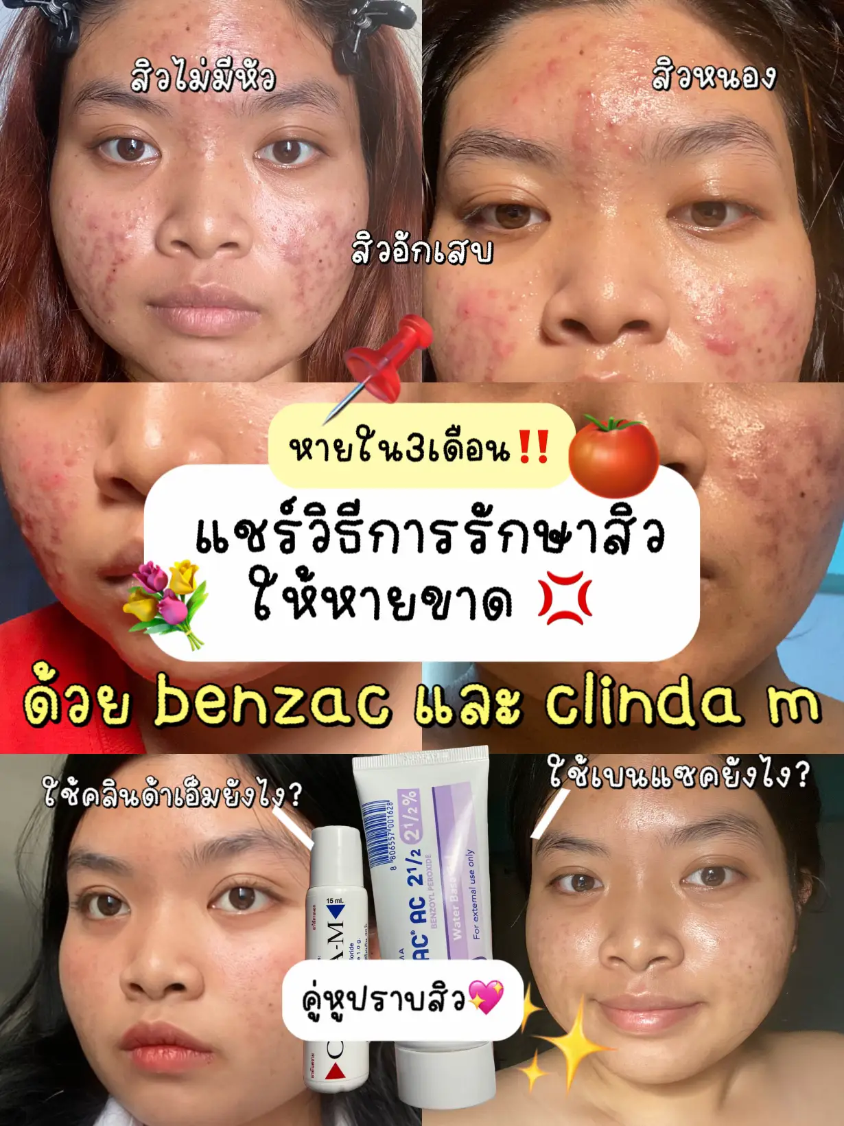 สิวหายใน 3 เดือน ด้วย benzac และ clinda m 👍🏻 | แกลเลอรีที่โพสต์โดย พอย ...