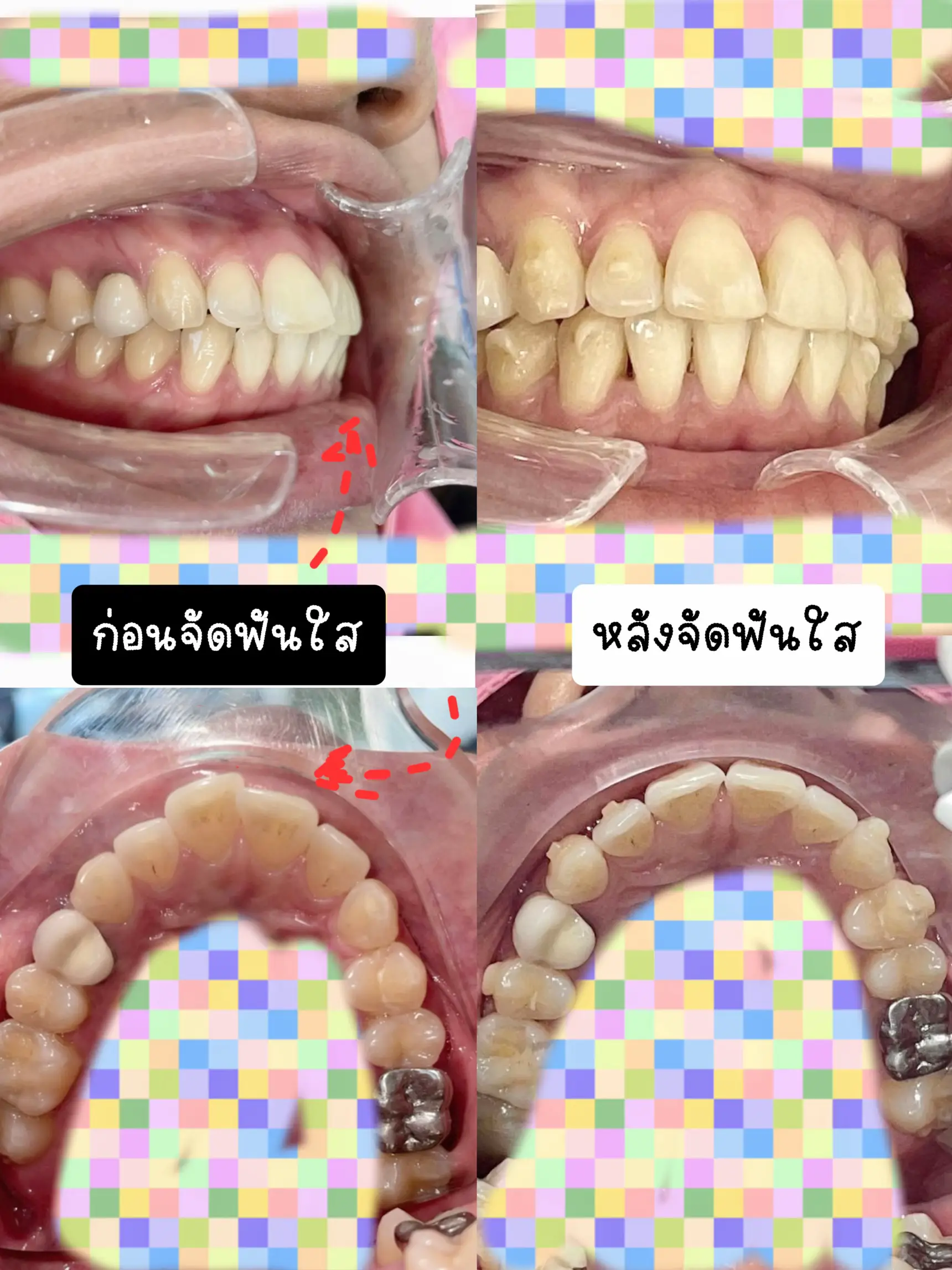 จัดฟันแบบไหน เหมาะกับเราที่สุด | แกลเลอรีที่โพสต์โดย hotmadame 👄 | Lemon8