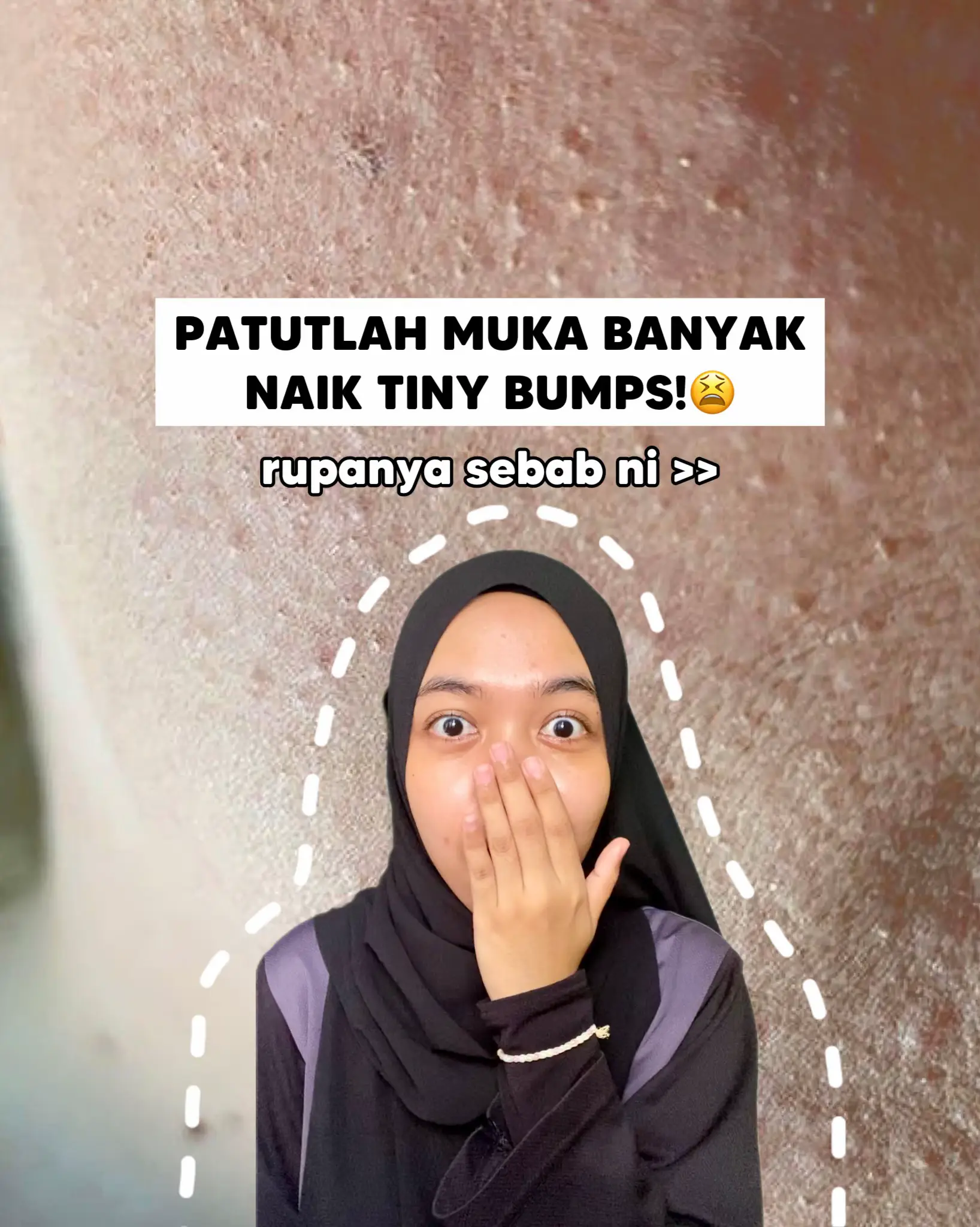 punca-tiny-bumps-galeri-disiarkan-oleh-aqish-beau-tips-lemon8