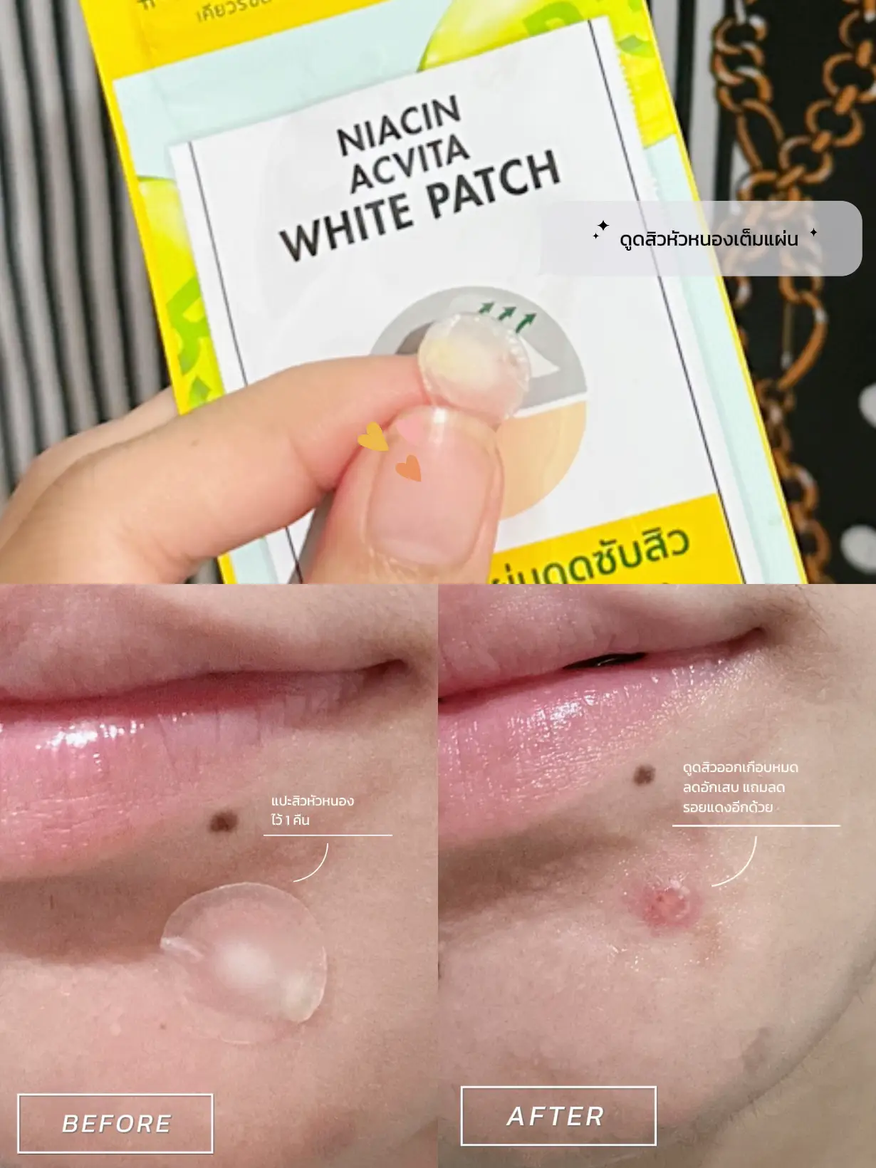 รีวิวแผ่นแปะลดรอยสิว Curesys Dark Spot AC Patch | แกลเลอรีที่โพสต์โดย ...