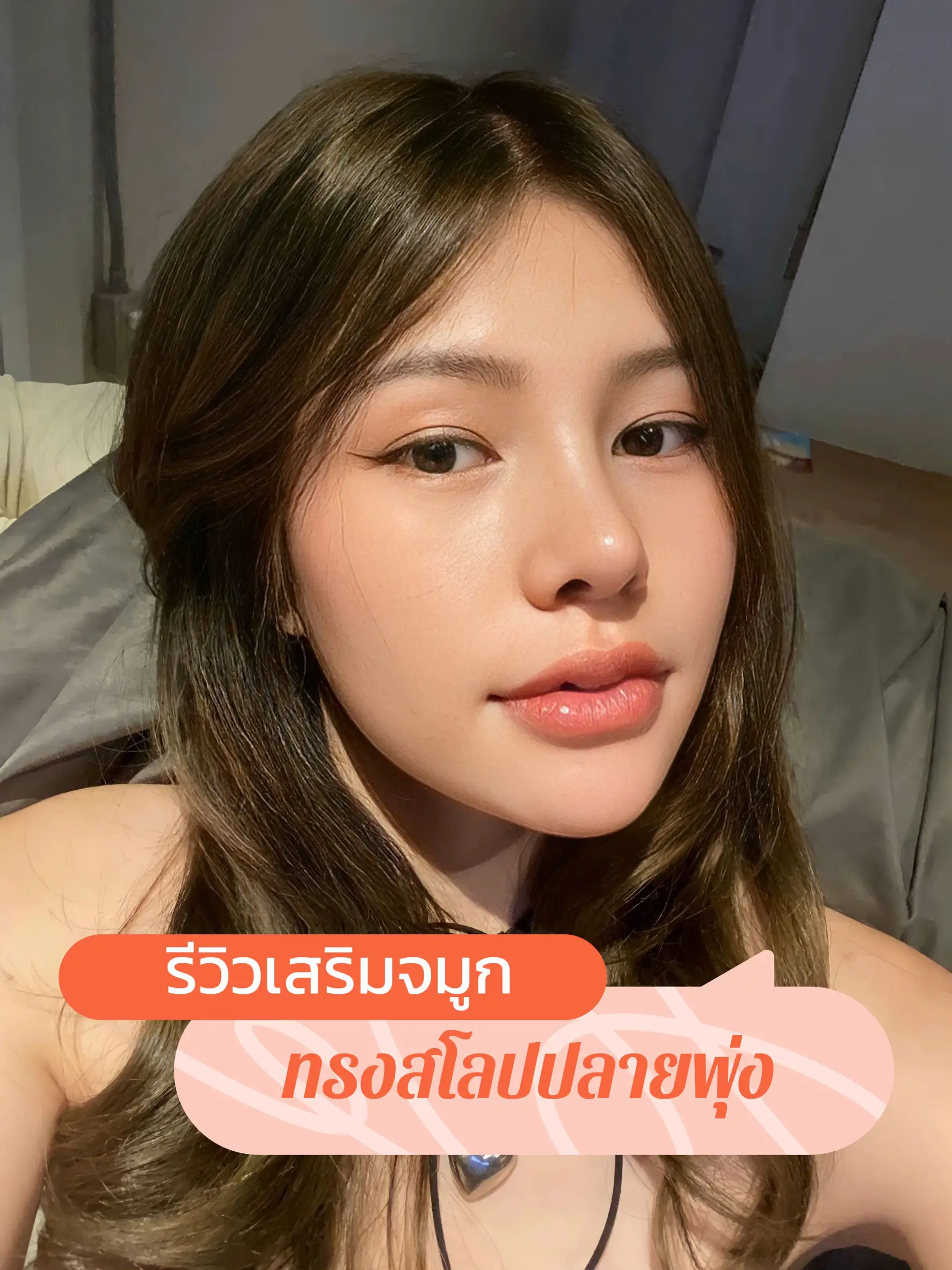 ✨รีวิวเสริมจมูกทรงสโลปปลายพุ่ง พร้อมเทคนิคที่ใช้ | แกลเลอรีที่โพสต์โดย De  Luna Clinic | Lemon8