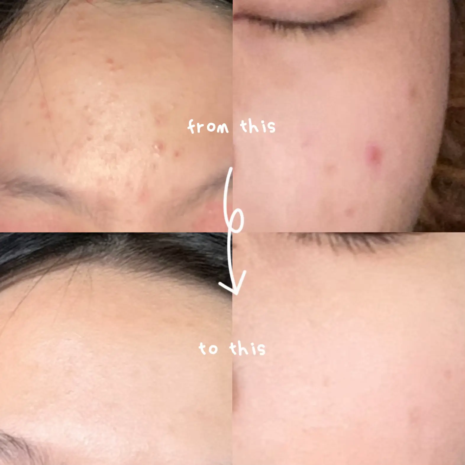 how-i-cured-my-acne-what-i-used-gallery-posted-by-chy-lemon8