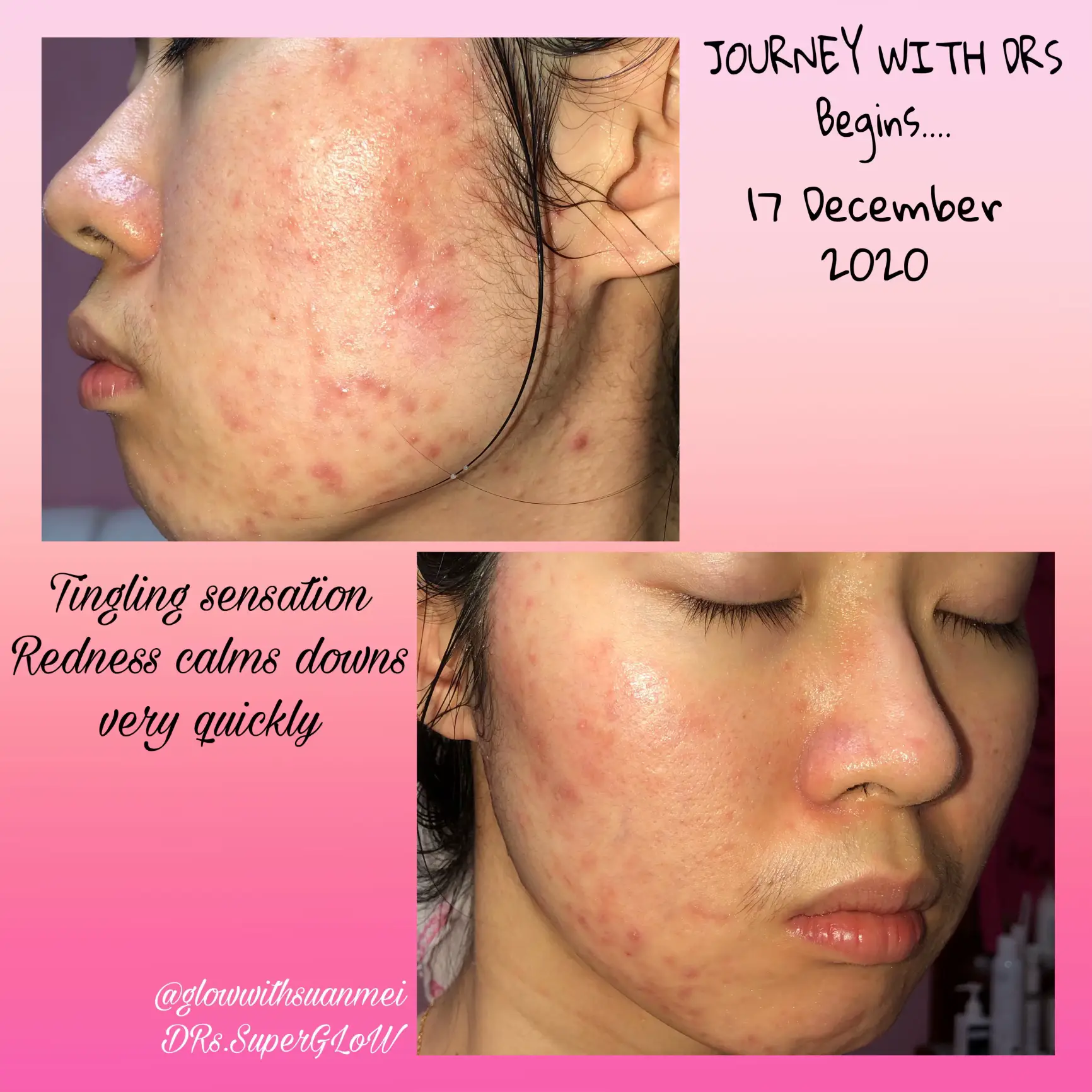 A skincare that I stick with 3 years! acne & clogs's images(1)