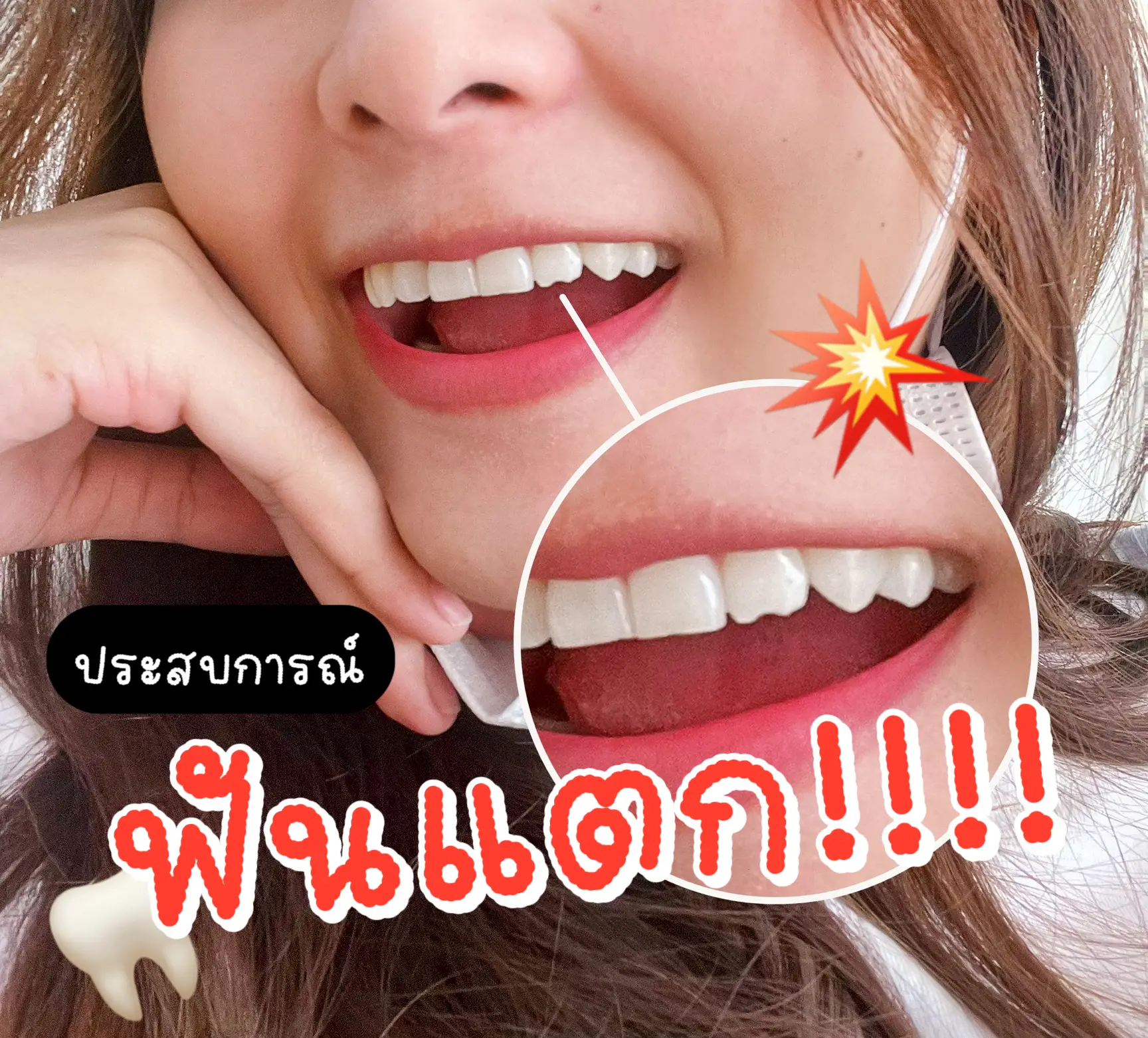 ประสบการณ์ฟันแตก!!!💥 | แกลเลอรีที่โพสต์โดย 𝙉𝙐𝙉𝙀 💖 | Lemon8