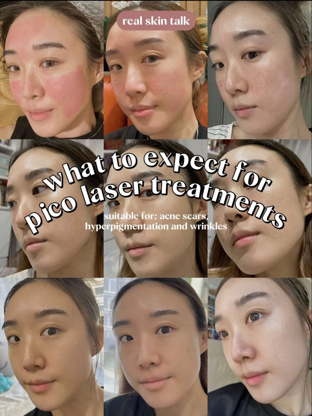 Pico Laser after 2 wks⚡️ Let’s talk skin treatments's images