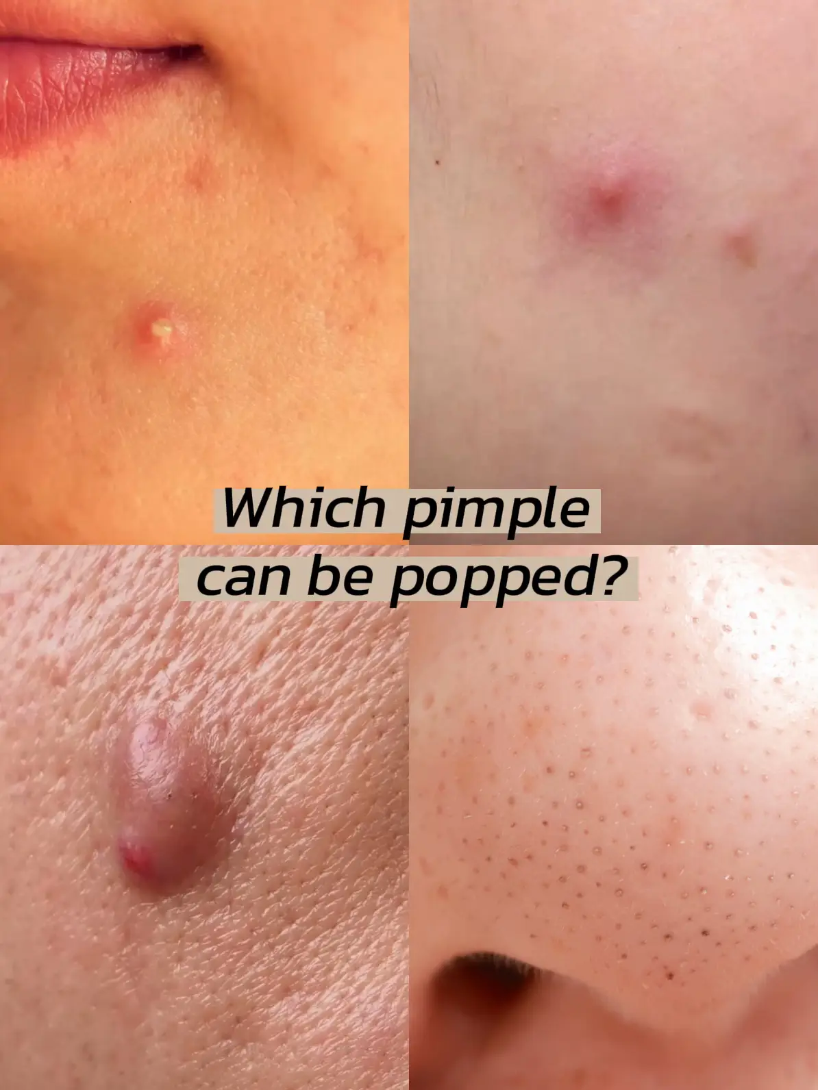 Identifying acne that can be extracted's images(0)