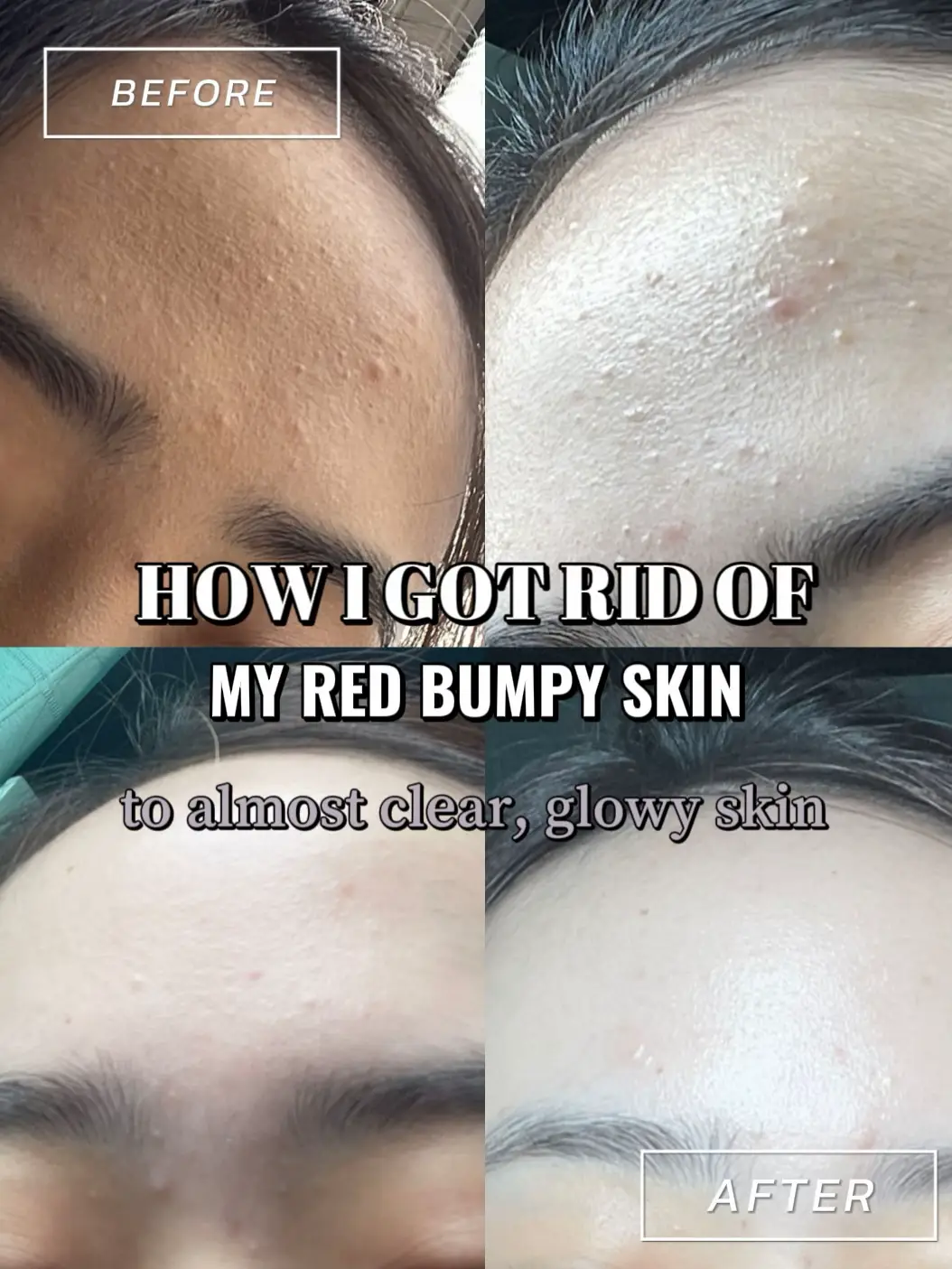 HOW I GOT RID OF BUMPY TEXTURED SKIN❗️'s images(0)