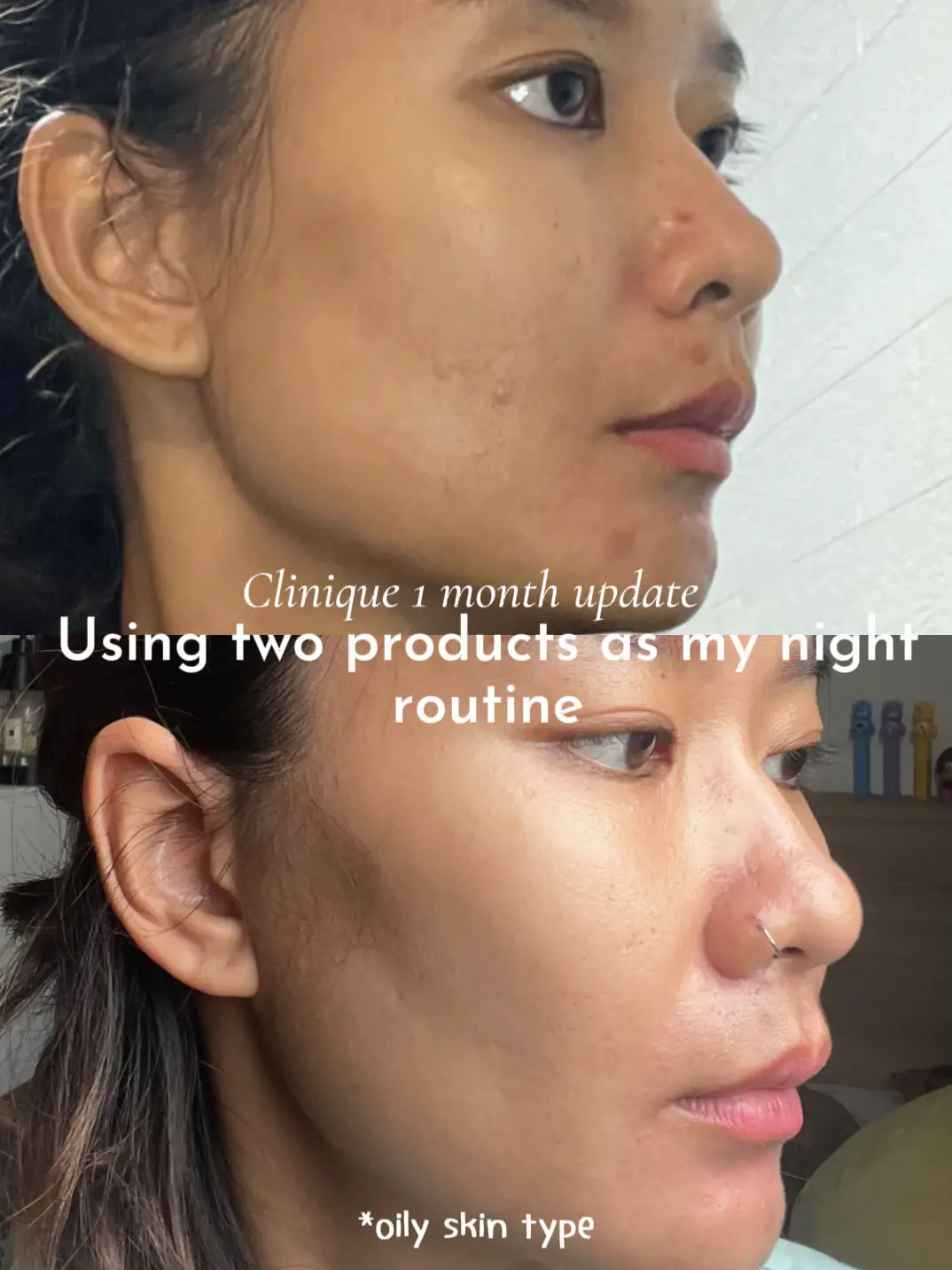 I TRIED OLIVE OIL SKINCARE FOR A MONTH - BEFORE & AFTER ACNE SKINCARE HACKS