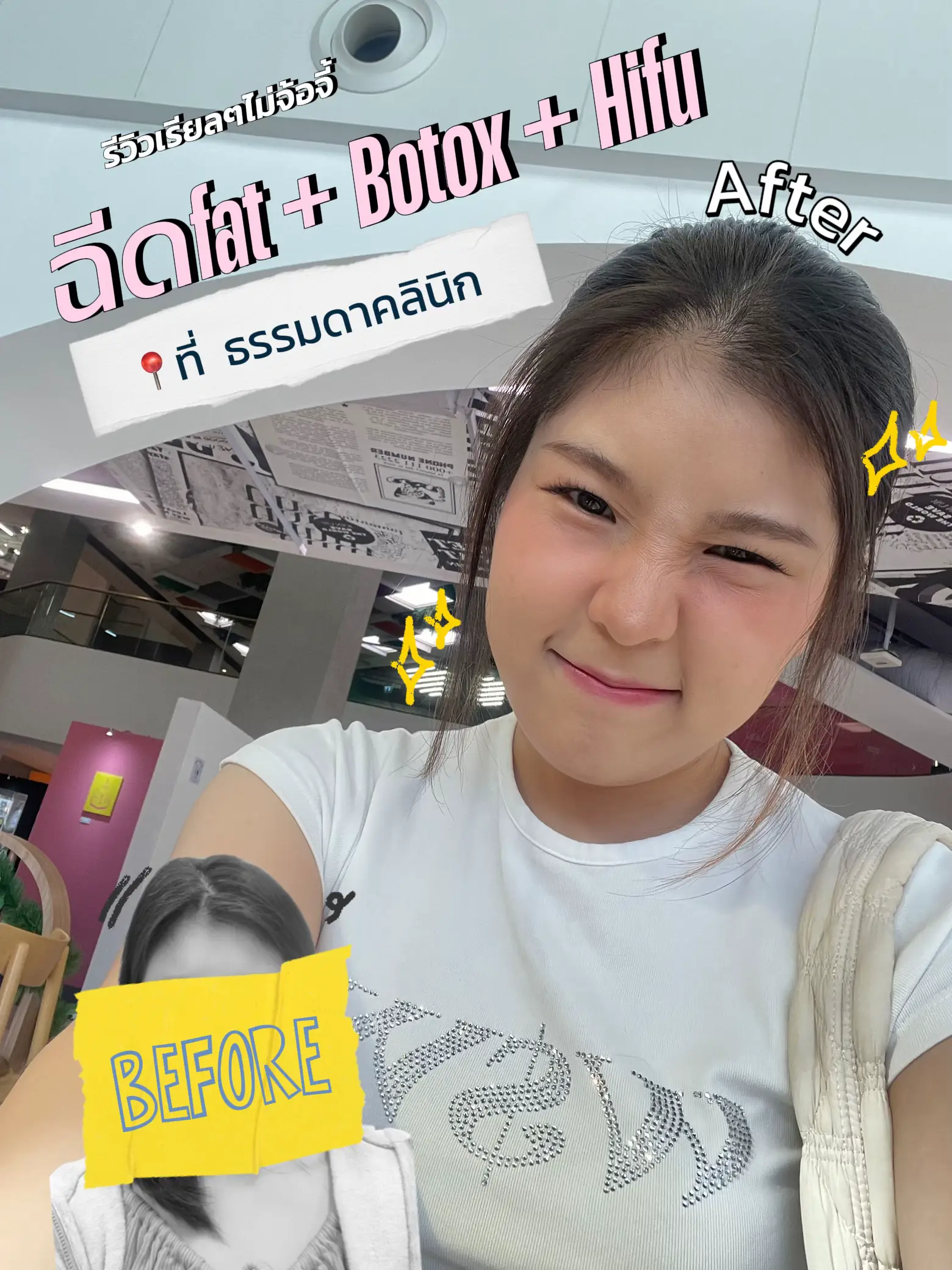 รีวิวเรียลๆ Fat+Botox+Hifu 📍ธรรมดาคลินิก | แกลเลอรีที่โพสต์โดย ...