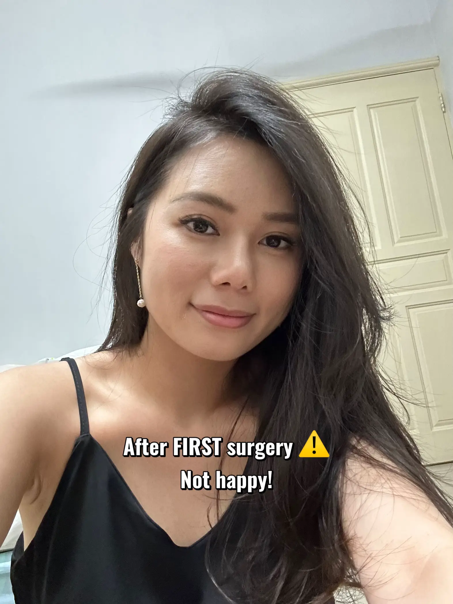 rhinoplasty-surgery-2-0-gallery-posted-by-sallest-lemon8