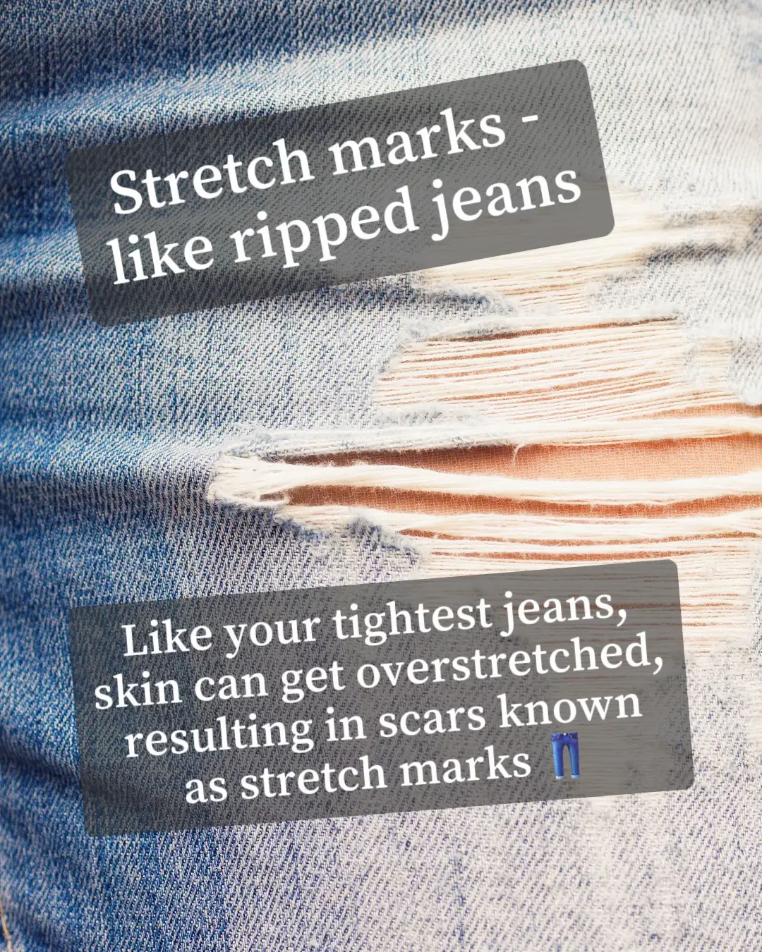 The Difference Between Stretch Marks and Cellulite
