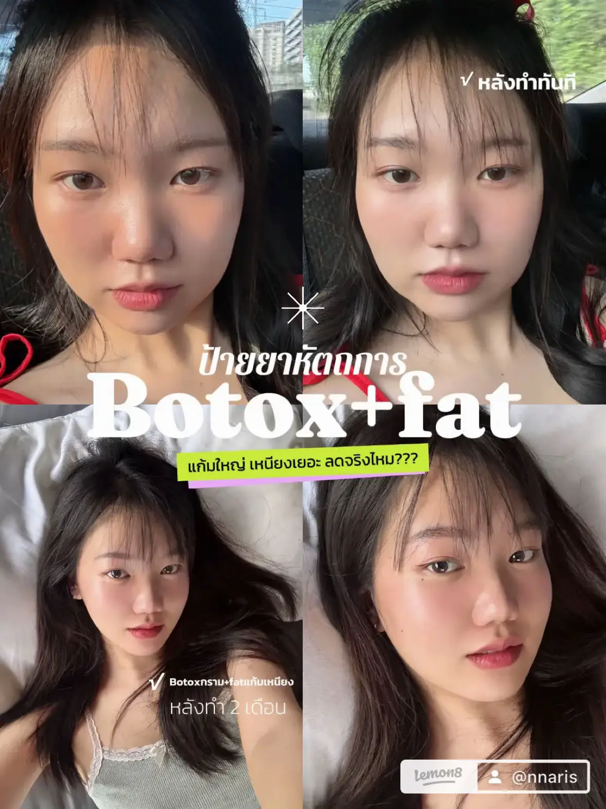 รีวิวเรียลๆ Fat+Botox+Hifu 📍ธรรมดาคลินิก | แกลเลอรีที่โพสต์โดย ...