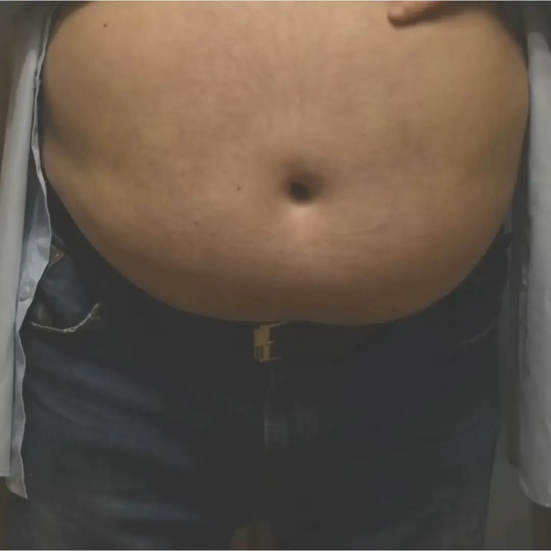 Does fat cavitation really work?