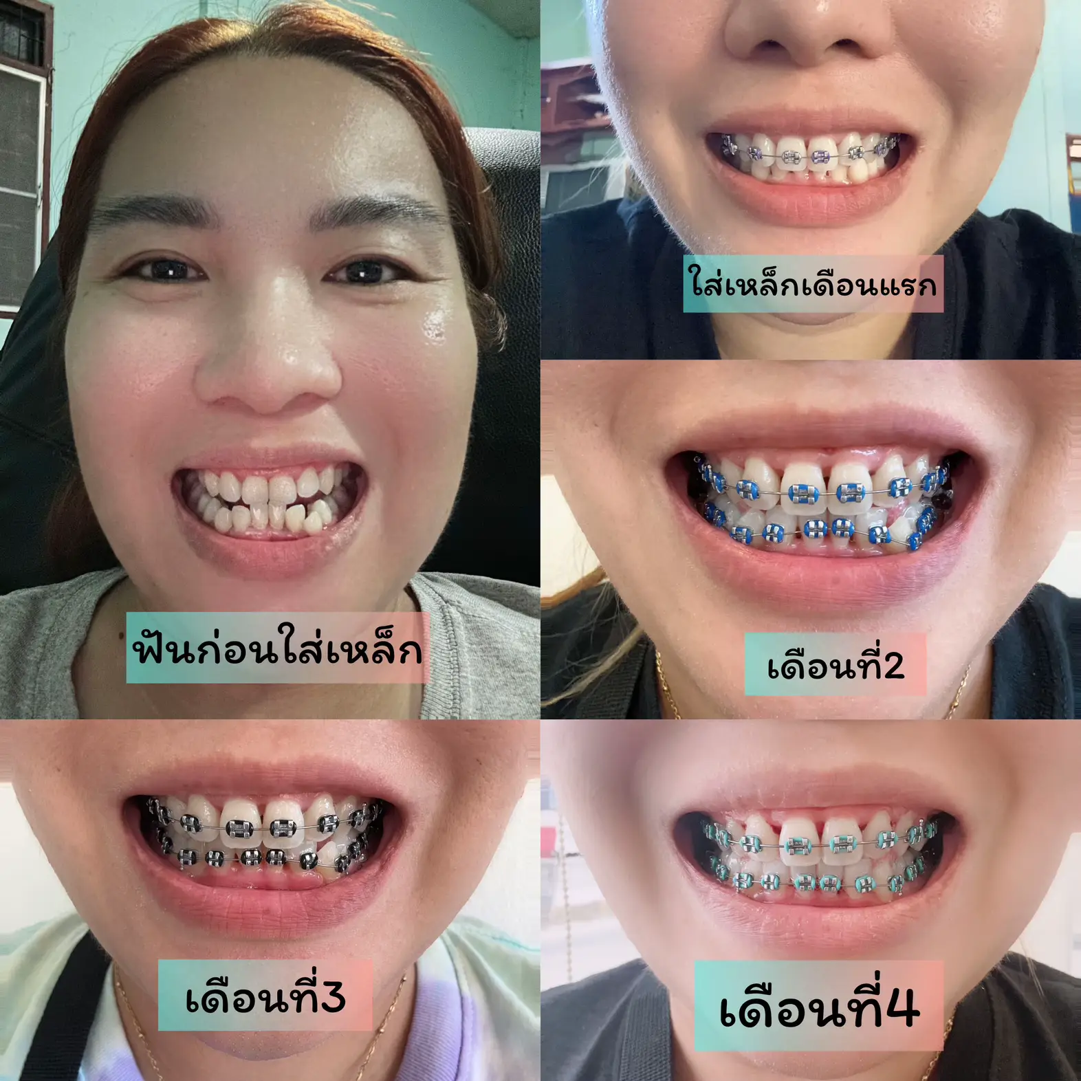 วิธีแก้เหล็กจัดฟันบาดแก้ม - การค้นหาใน Lemon8