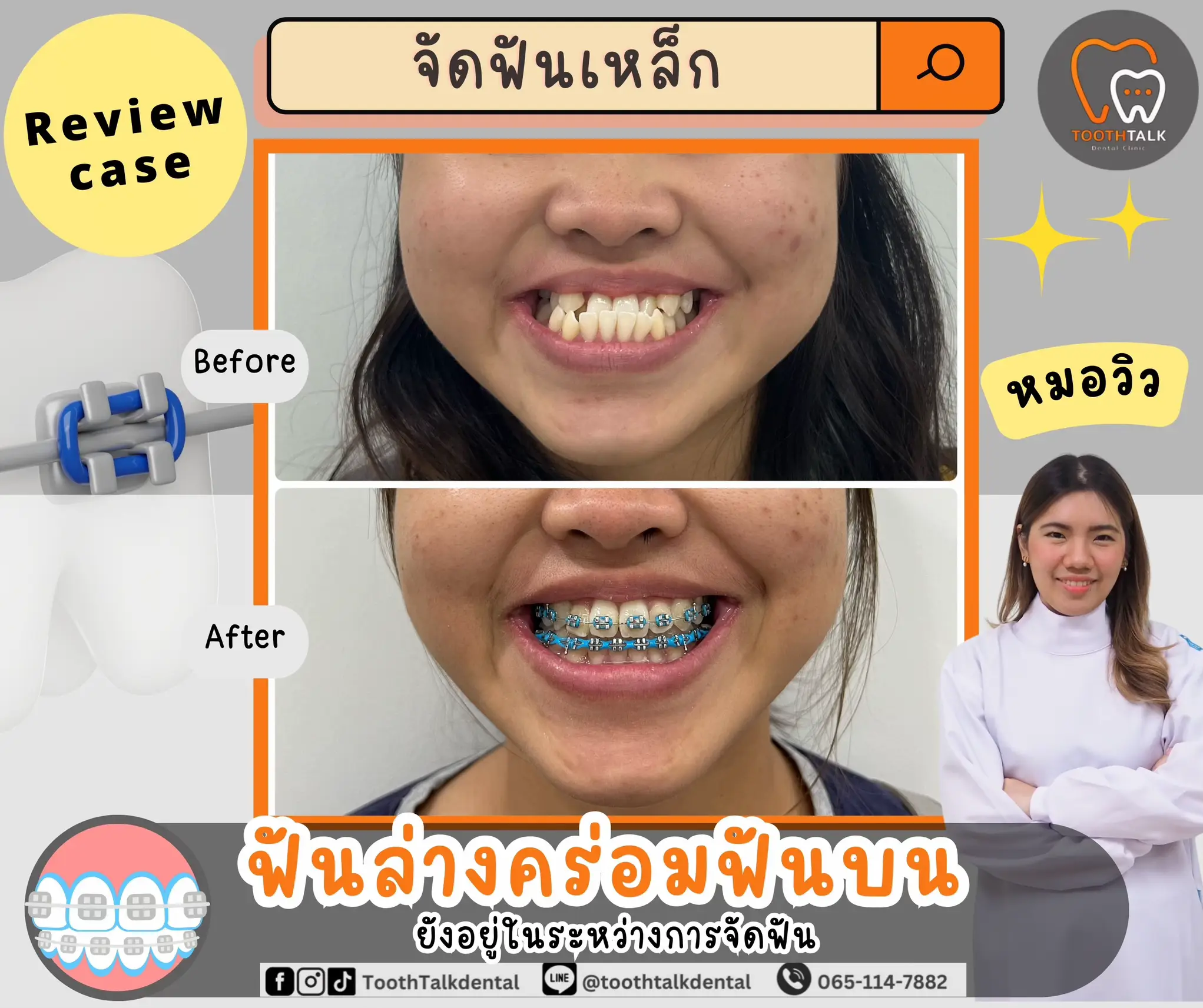 รีวิวเคสจัดฟัน | แกลเลอรีที่โพสต์โดย ToothTalk🦷💬 | Lemon8
