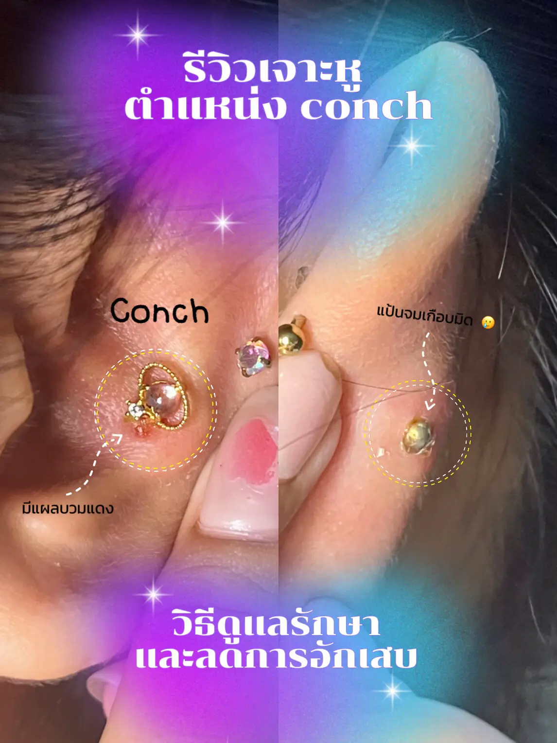 เจาะหู + รักษาตำแหน่ง Conch 