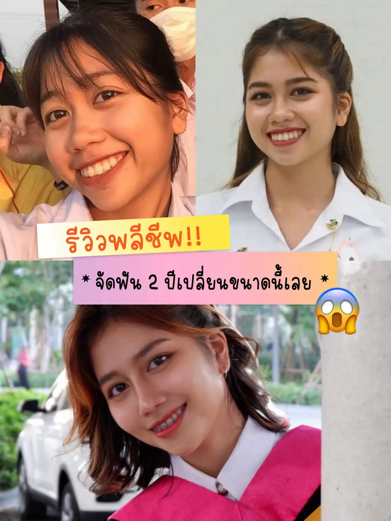 รีวิวพลีชีพ!! จัดฟันเปลี่ยนแบบปึ้งงง | แกลเลอรีที่โพสต์โดย 💘NAT🦄 | Lemon8