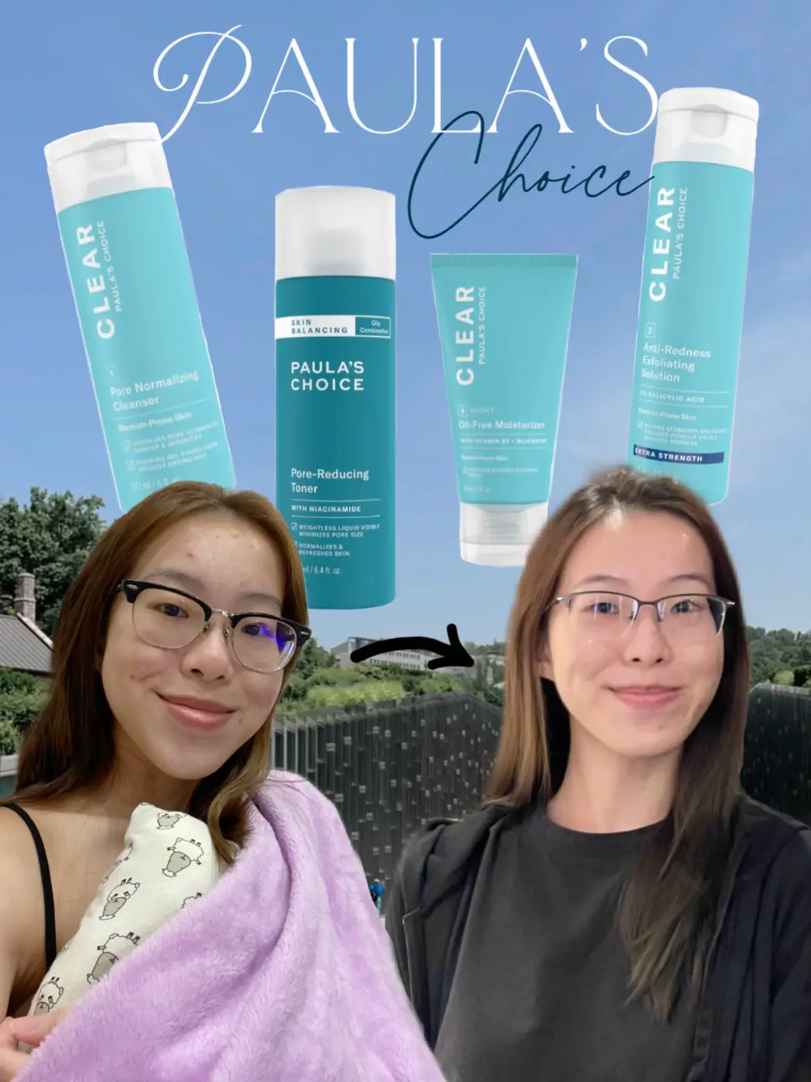 how i CLEARED my acne 😶‍🌫️🥺 PS THERE’S A SALE 🏃🏻‍♂️'s images(0)