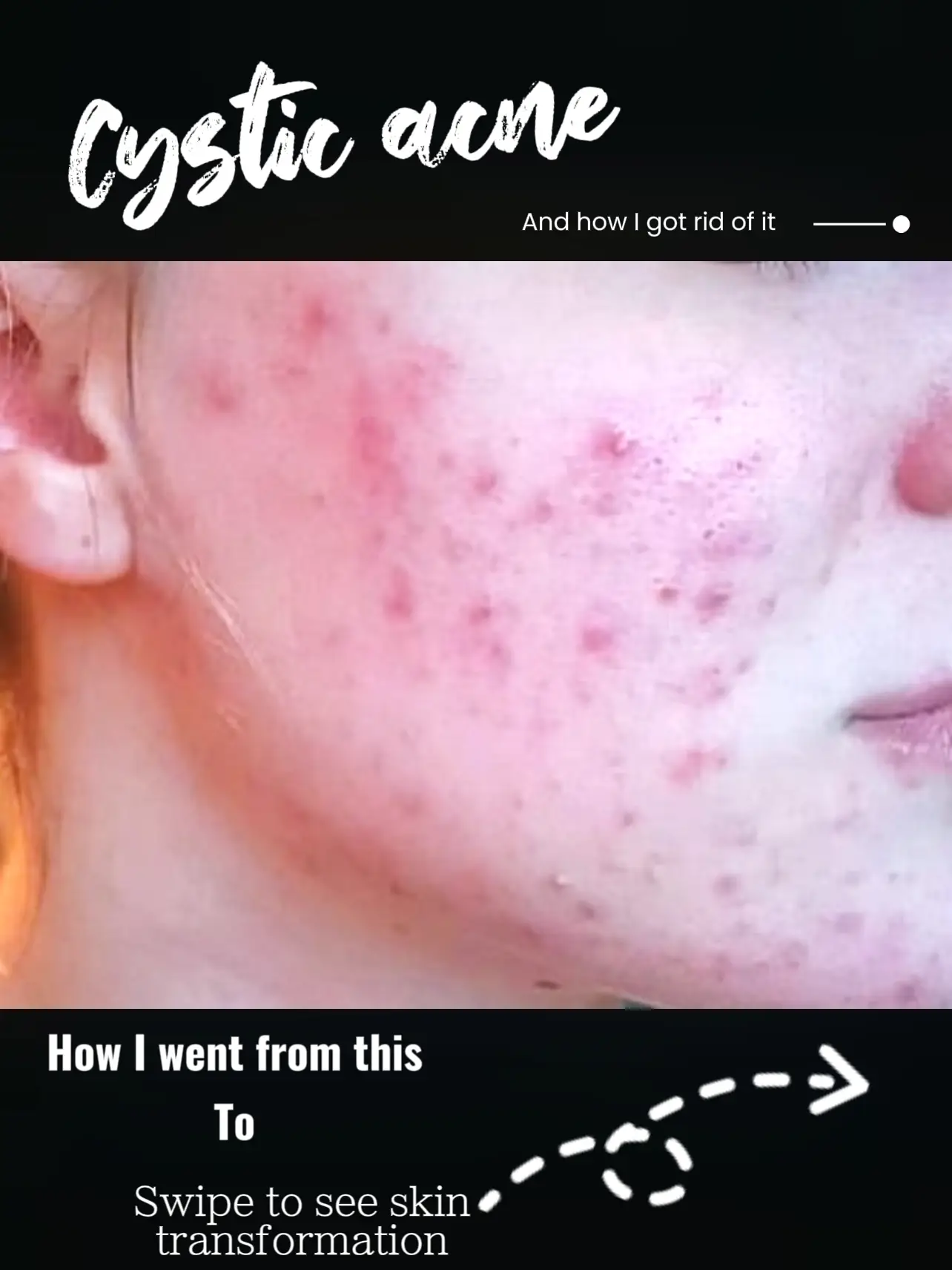 I had cystic acne so bad Gallery posted by Elizabeth Lemon8
