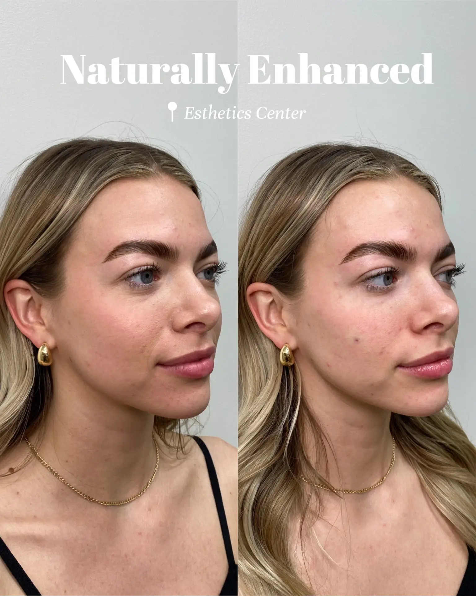 Loreal Revitalift Filler Before-And-After Results - Lemon8 Search