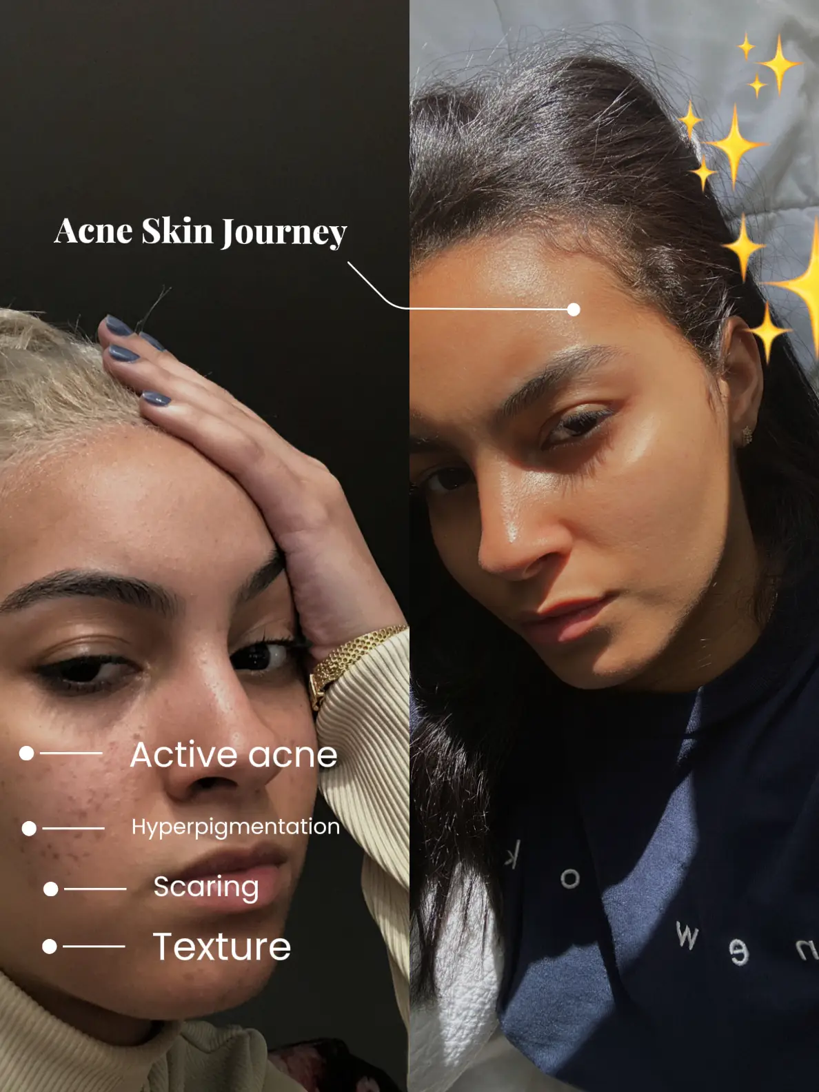 My Acne Skin Journey🪞 | Galeri diposting oleh Carina | Lemon8