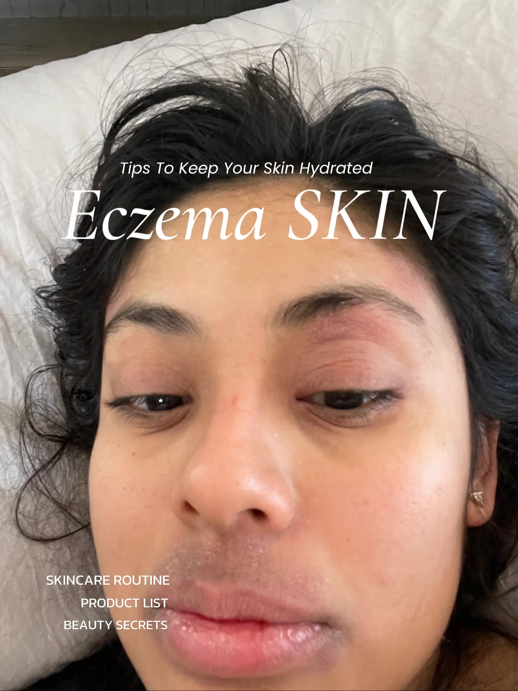 Eczema Skin Gallery posted by Carla Castro Lemon8
