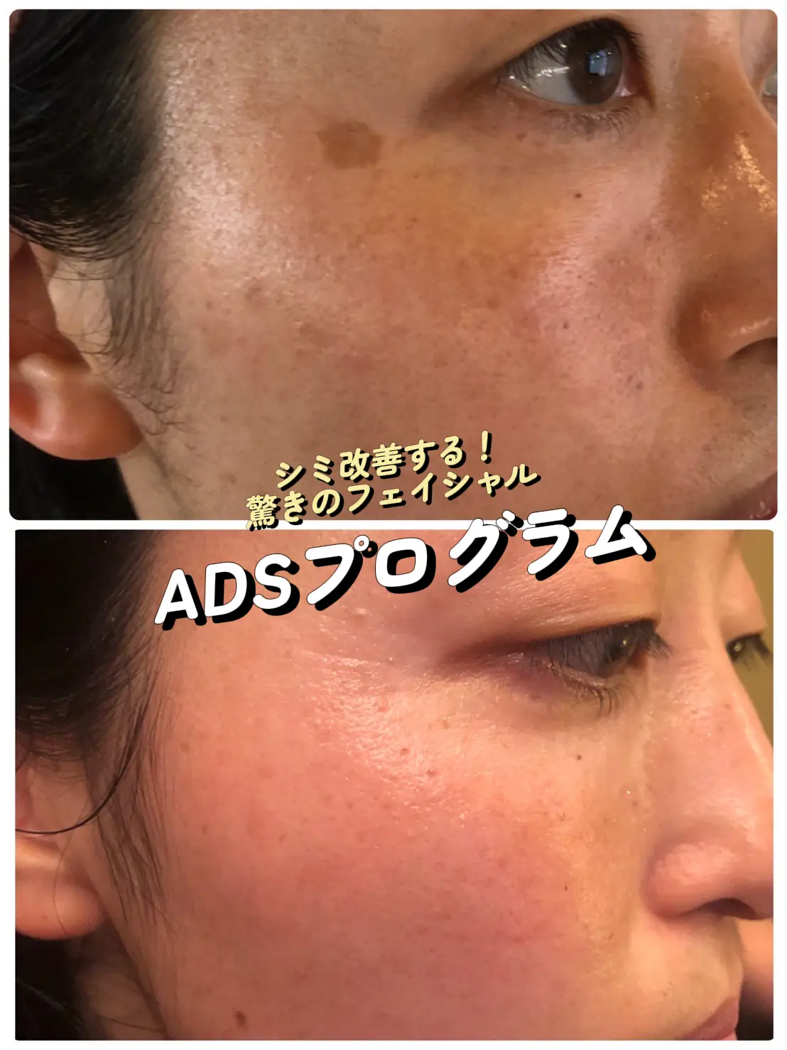 ドクターリセラ ADSポイント 20枚 8800円相当 💎ドクターリセラ「ADS リピートセットキャンぺーン」がやってき