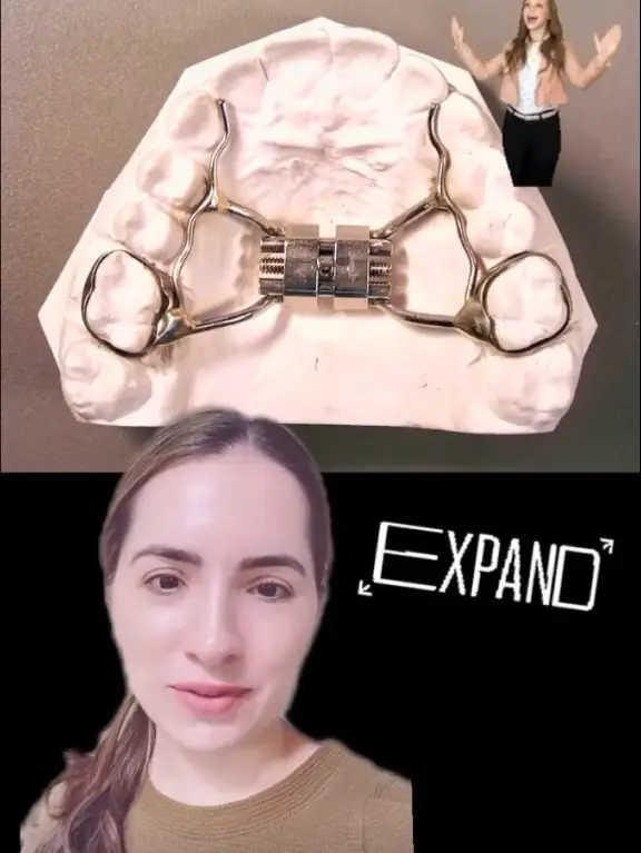 What is a Palatal Expander? Video published by Dr. Brothers Lemon8