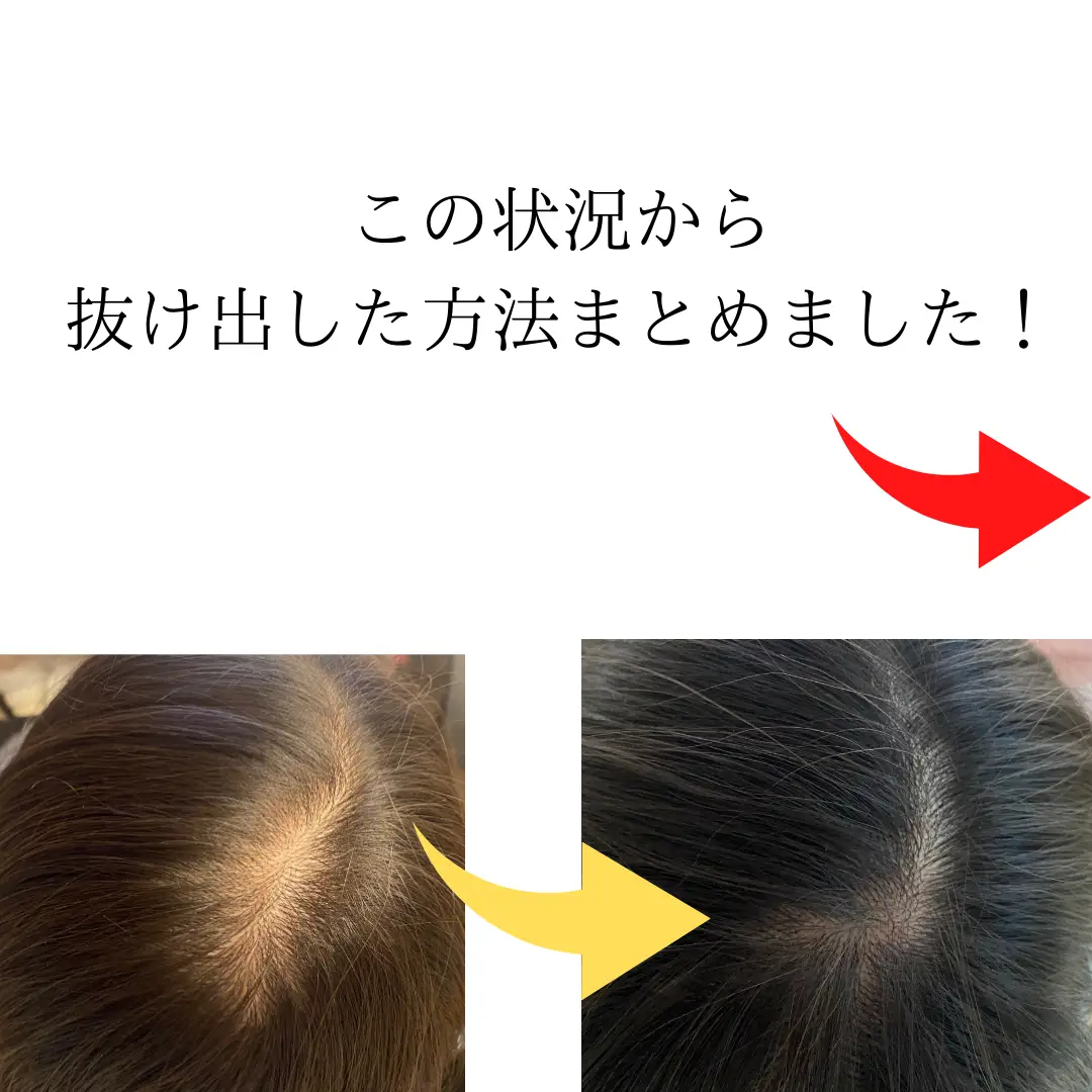 何やっても髪抜ける… | とも★薄毛に悩む40歳が投稿したフォトブック | Lemon8