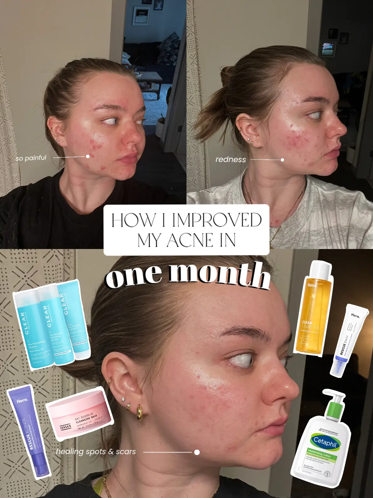 THE PLAN THAT CLEARED MY HORMONAL ACNE ☁️🤍's images
