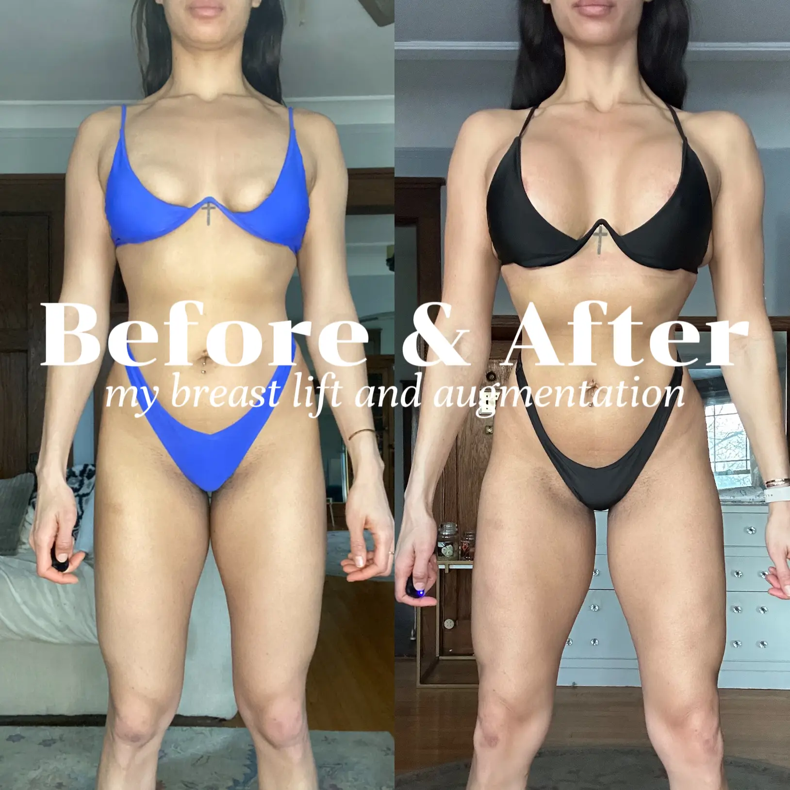 Foto de Cropped shot of young tanned woman in bra before and after breast  augmentation with silicone implants. The result of a breast lift. Breast  size correction on white background. Plastic surgery