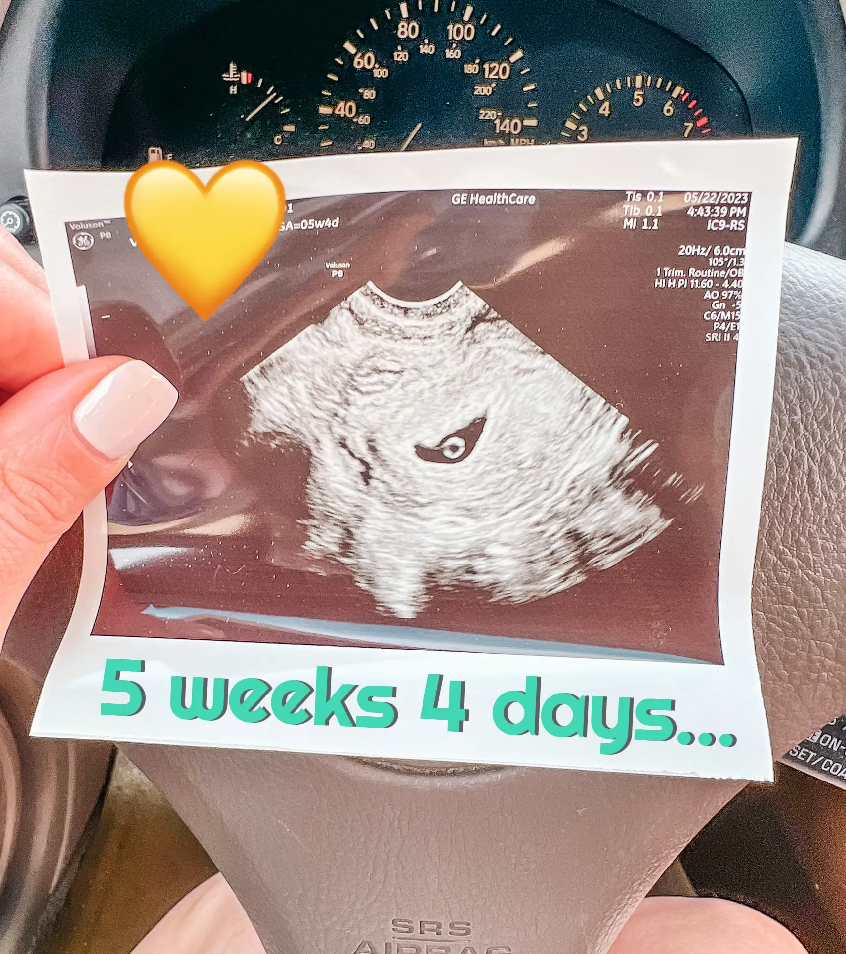 7w5d Brown Discharge? Tmi pic - May 2019 Babies, Forums