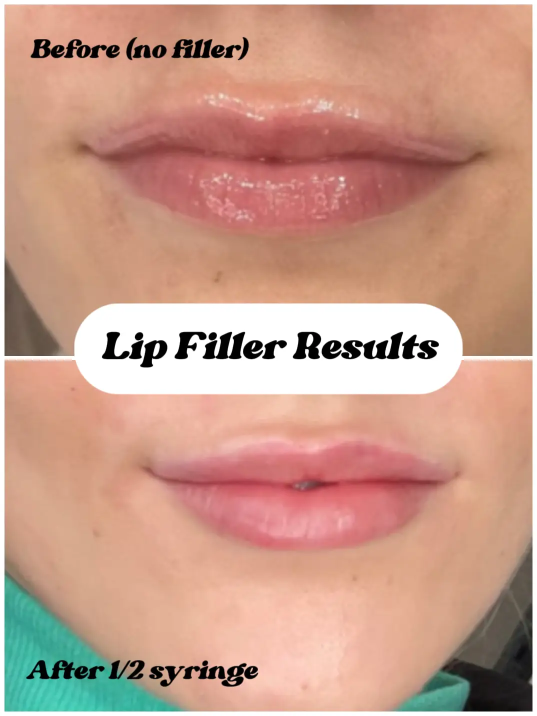 Lip Injections: 9 Things I Wish I'd Known Before Getting Them