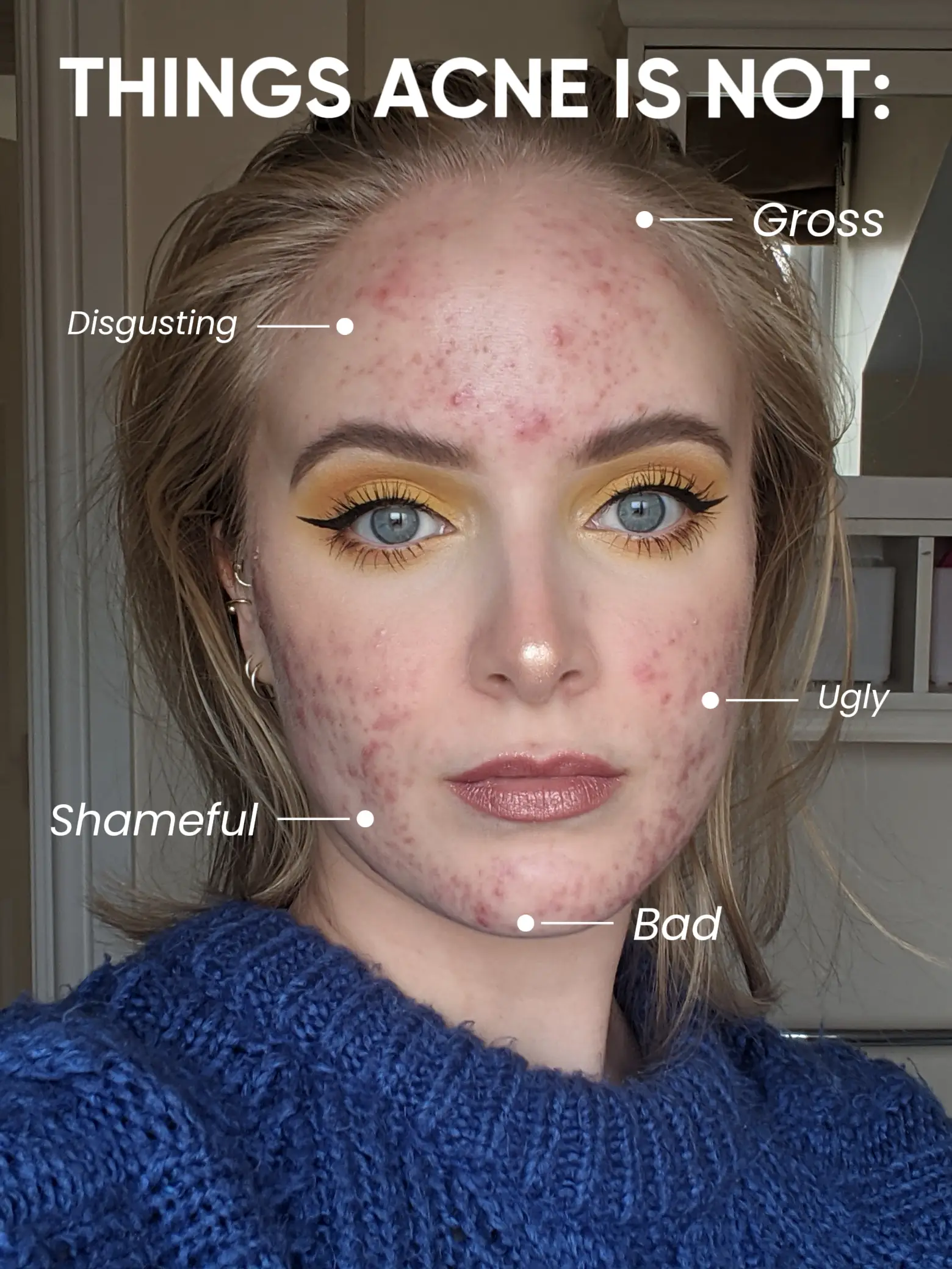 THINGS ACNE IS NOT:'s images