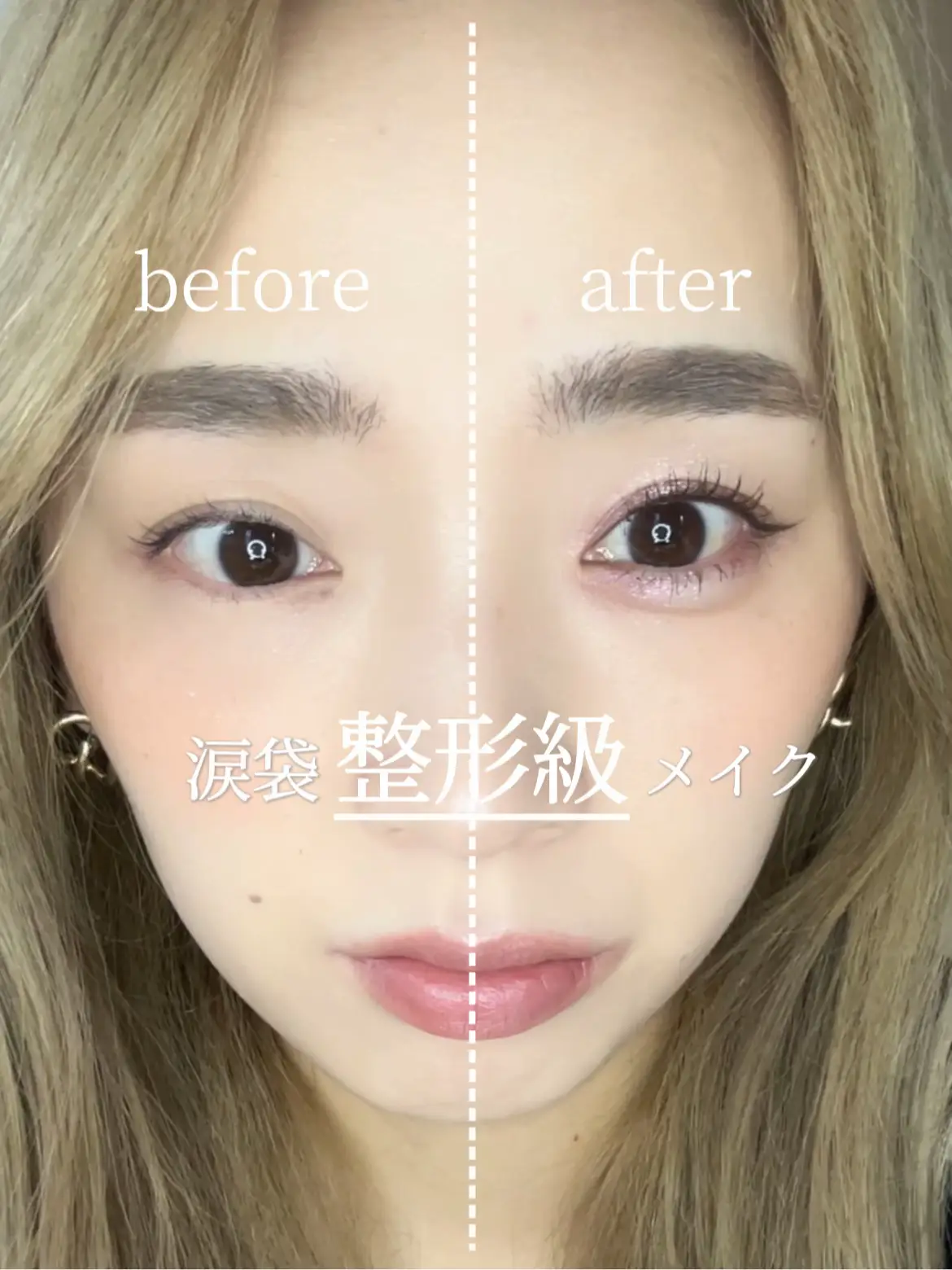 Eye bag plastic surgery? Makeup ❤ ︎