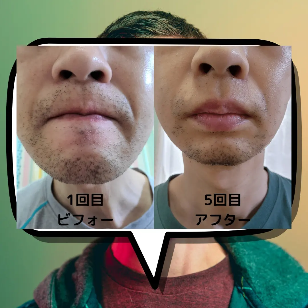 トリア レーザー脱毛 髭 ヒゲ 【公式通販】