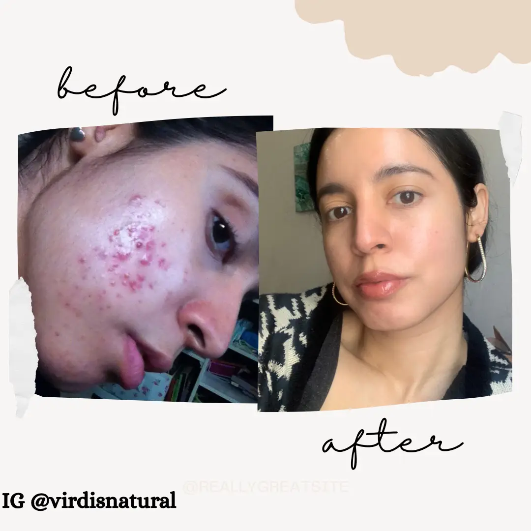 How cleared my adult acne 's images