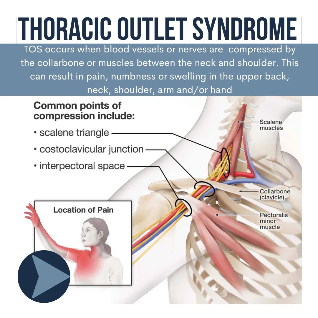Exercises to Heal Thoracic Outlet Syndrome