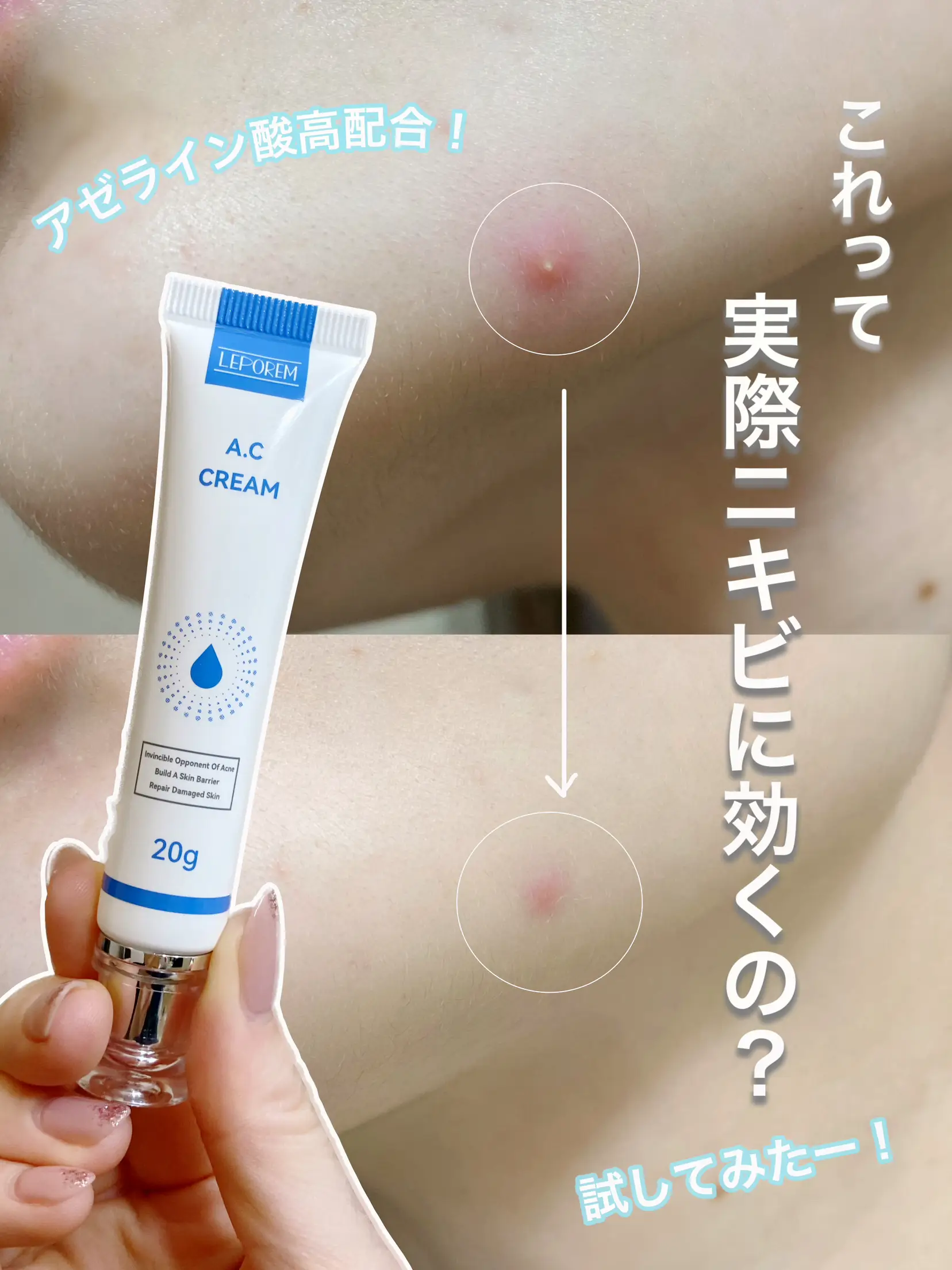 ルポレム LEPOREMアゼライン酸 ニキビ クリーム15 20g 2本 - フェイス