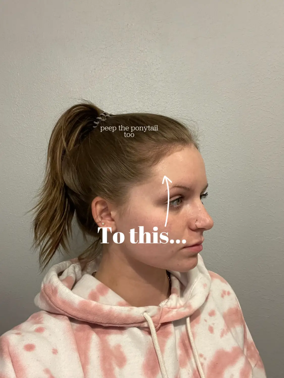 17 top Scandinavian Hairline Before and After ideas in 2024