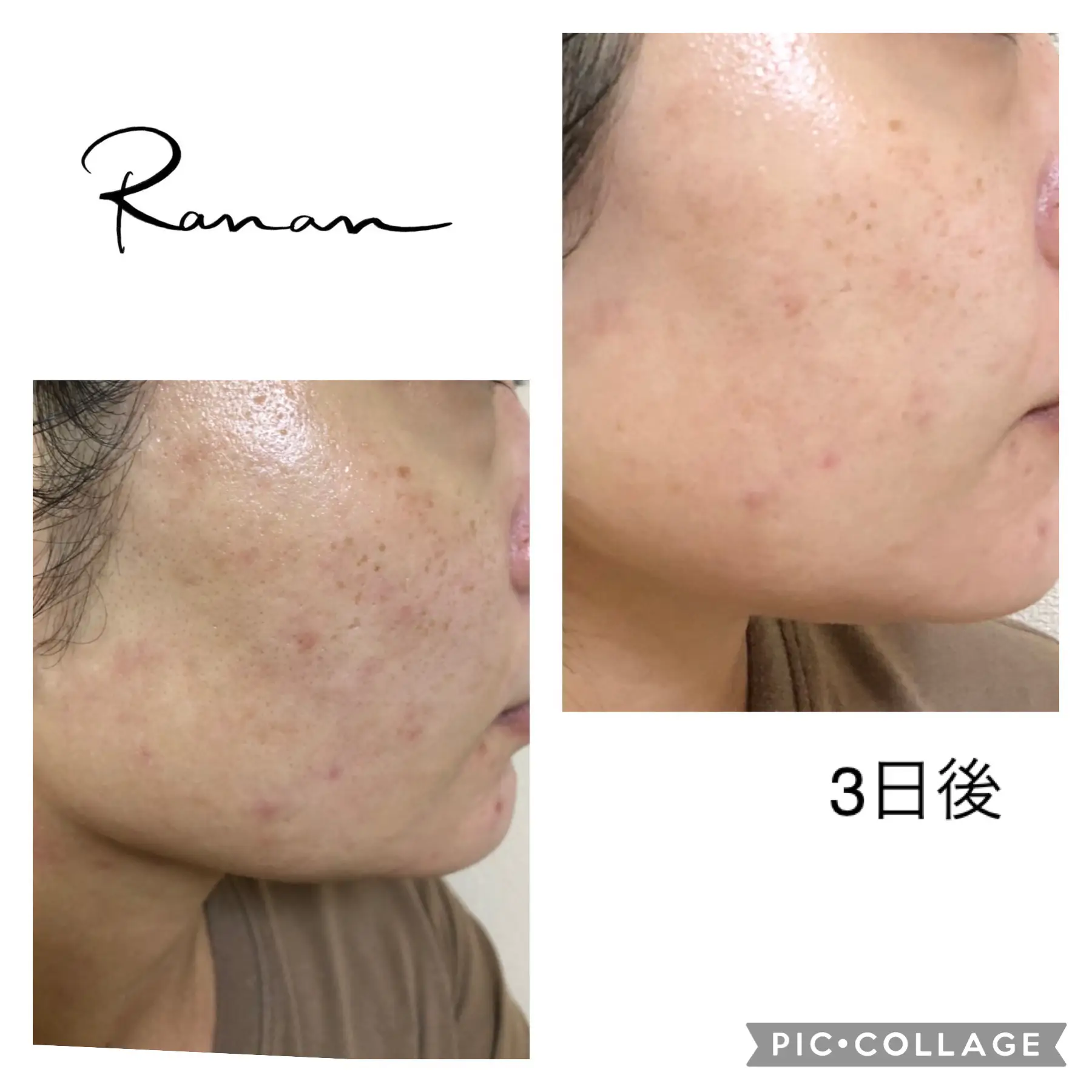 1台8役】フェイシャル 業務用 毛穴洗浄 ハイドラフェイシャル 美顔器