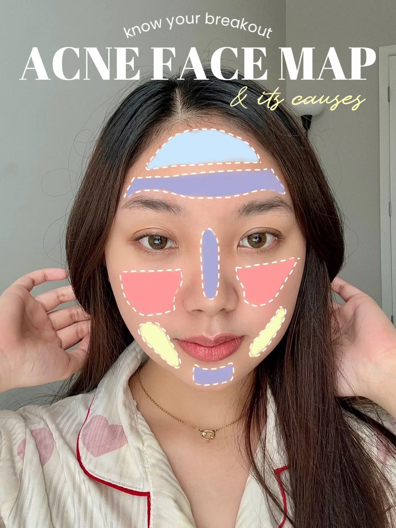 ACNE FACE MAP: Know your Breakouts & its Causes! 💯's images