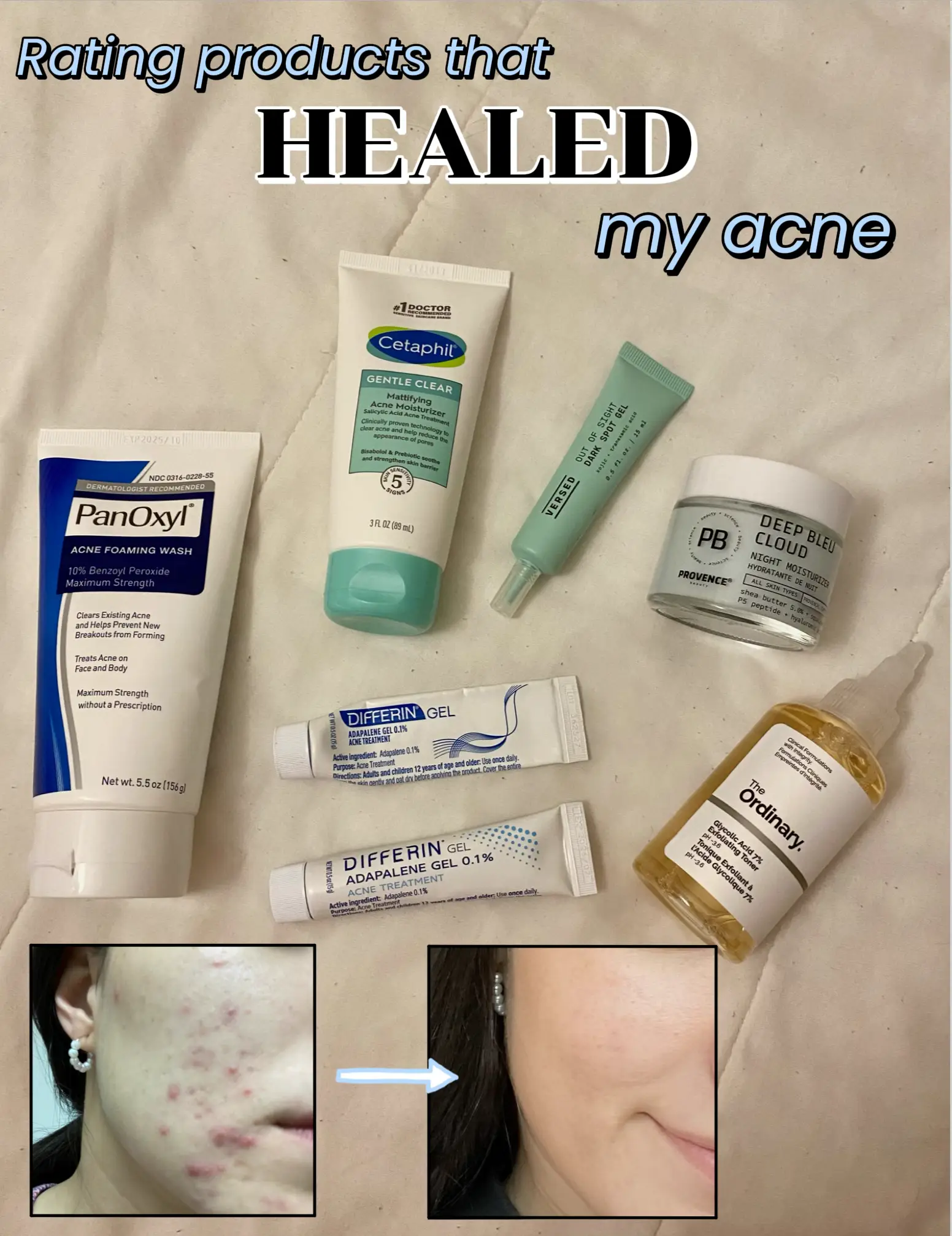 A Simple Nighttime Routine for Acne-Prone Skin  Serious skin care, Acne  prone skin care, Skin care solutions