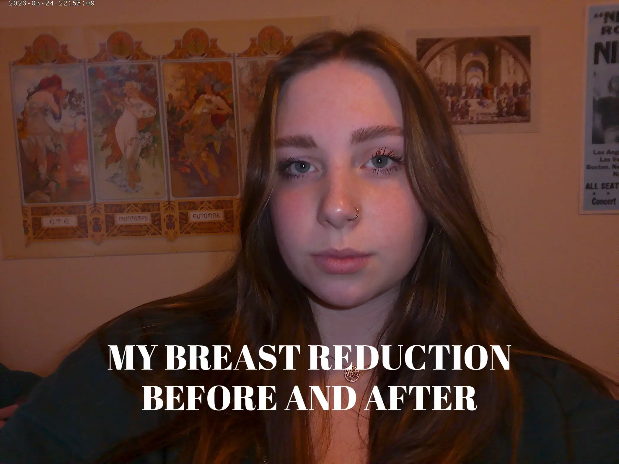 Posting my breast reduction journey on IG X SO HAPPY #breastreduction