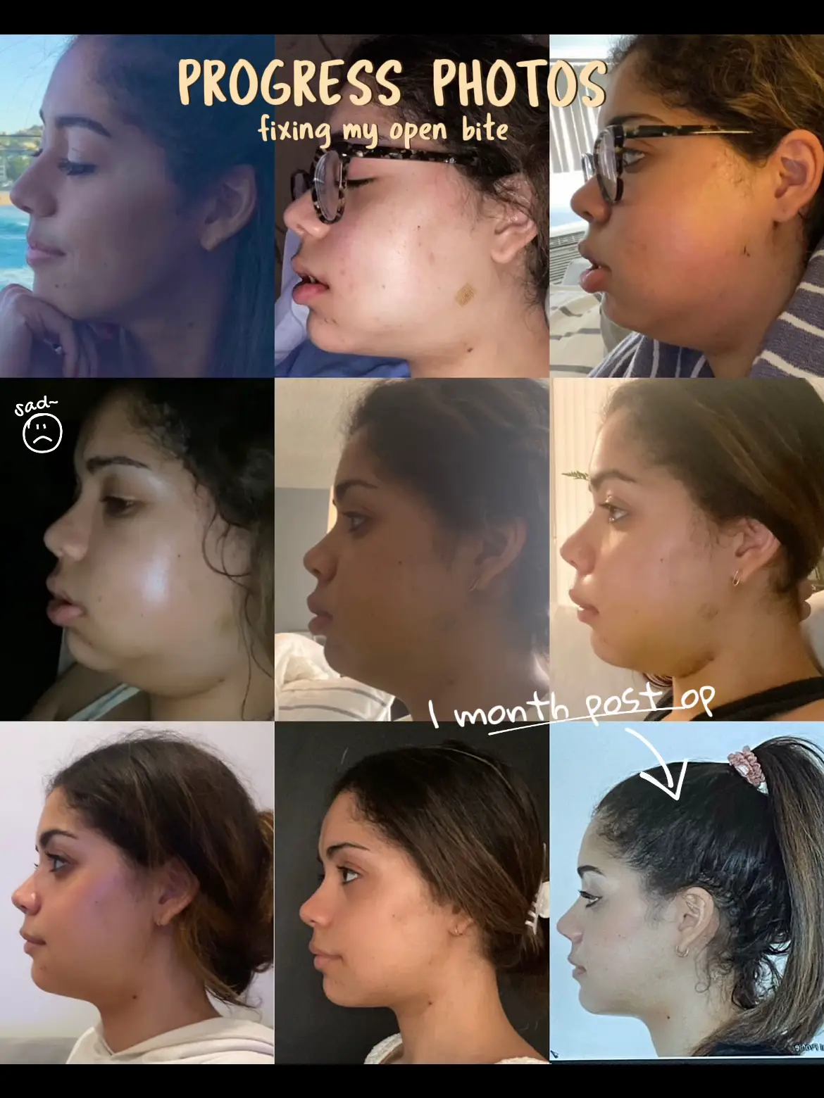 Jaw Surgery for Bite Correction - Lemon8 Search