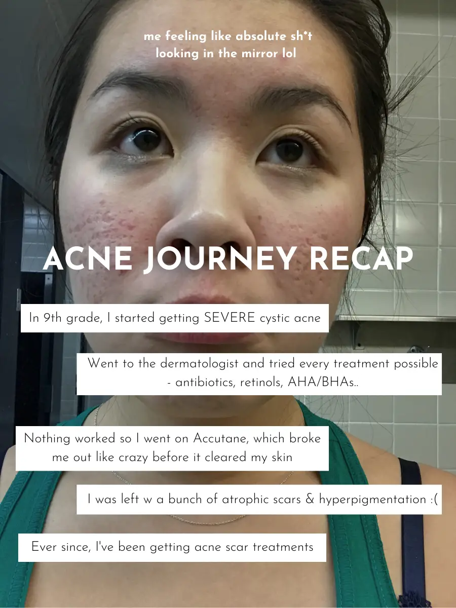 This Woman's Accutane Transformation Photos Went Viral — Before and After  Acne Photos